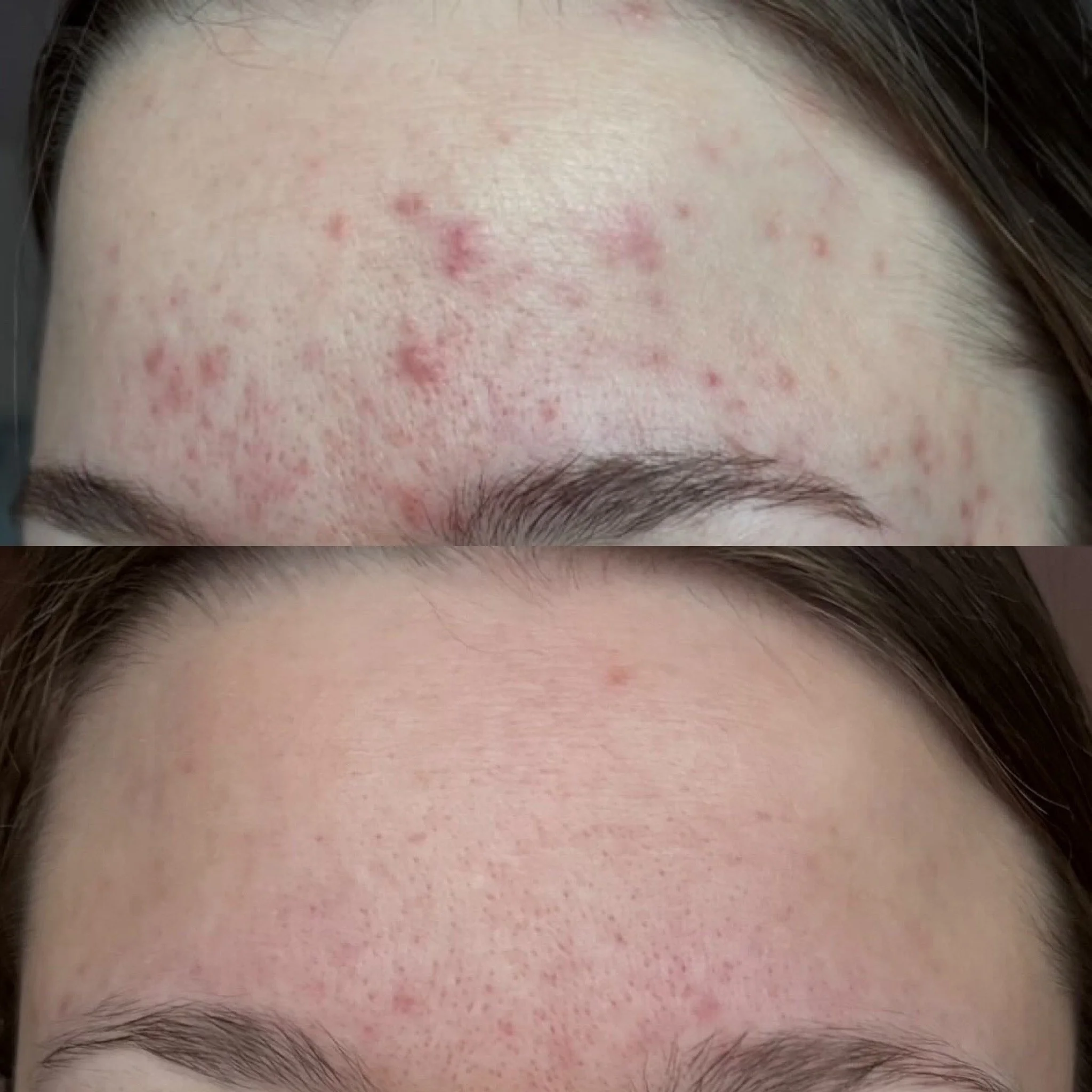 Acne Start -etäpalvelu ja sen jälkeen yksilöllinen tuotekokonaisuus kotona.
