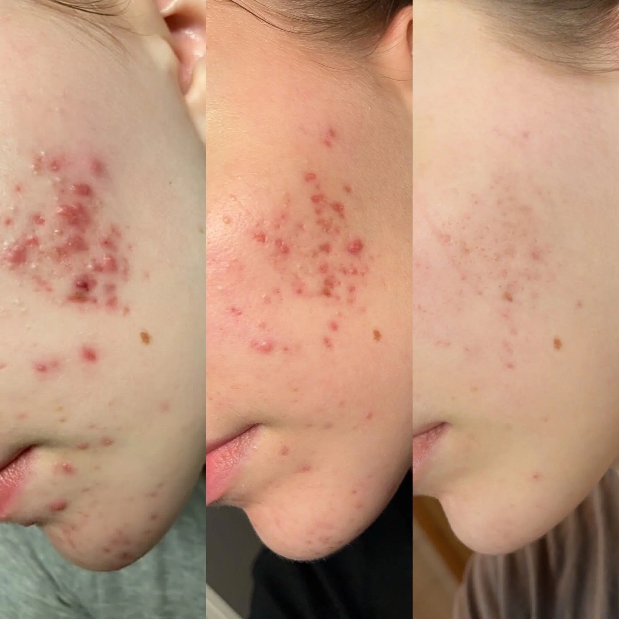 Acne Start -etäpalvelu aknen hoidon aloitus sekä vaurioiden korjaus.