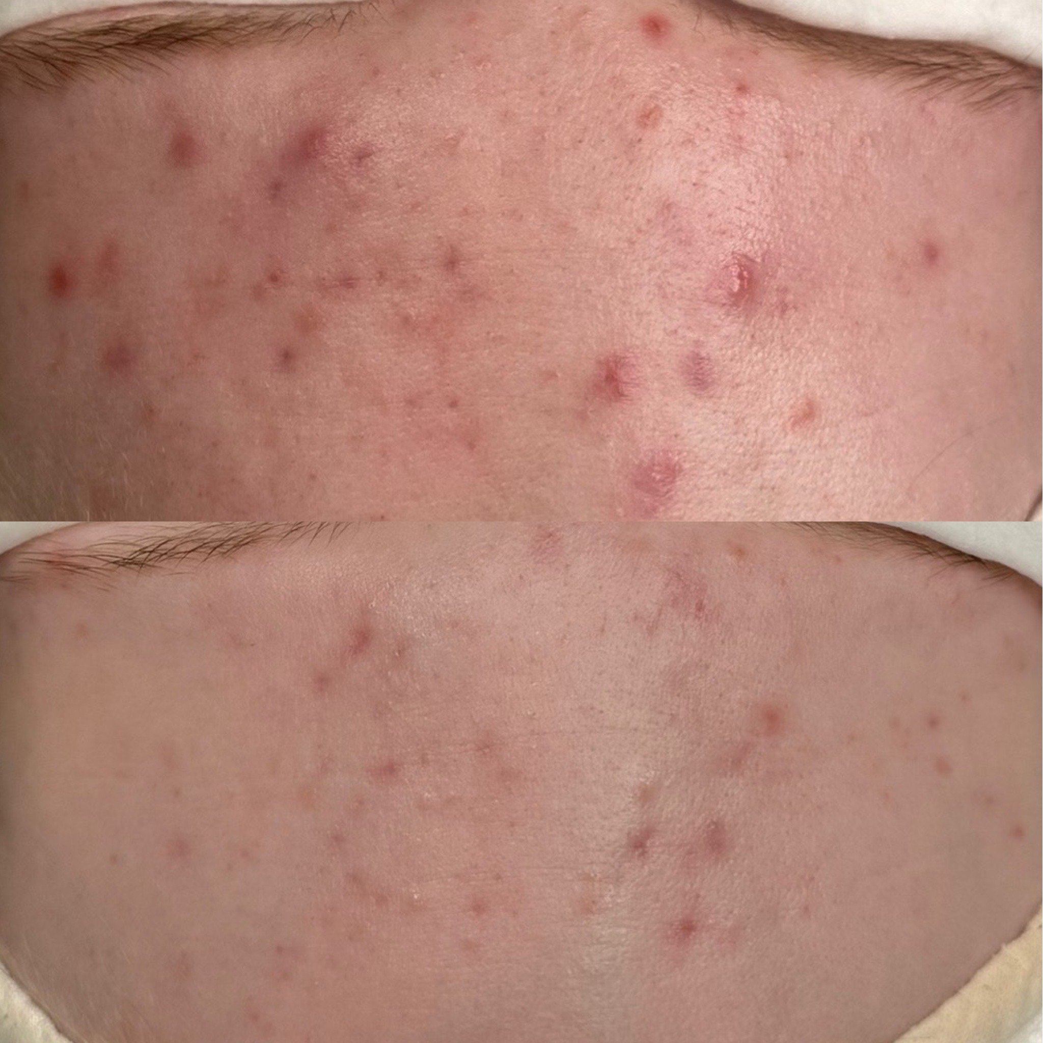 Acne Start kauneushoitolassa.