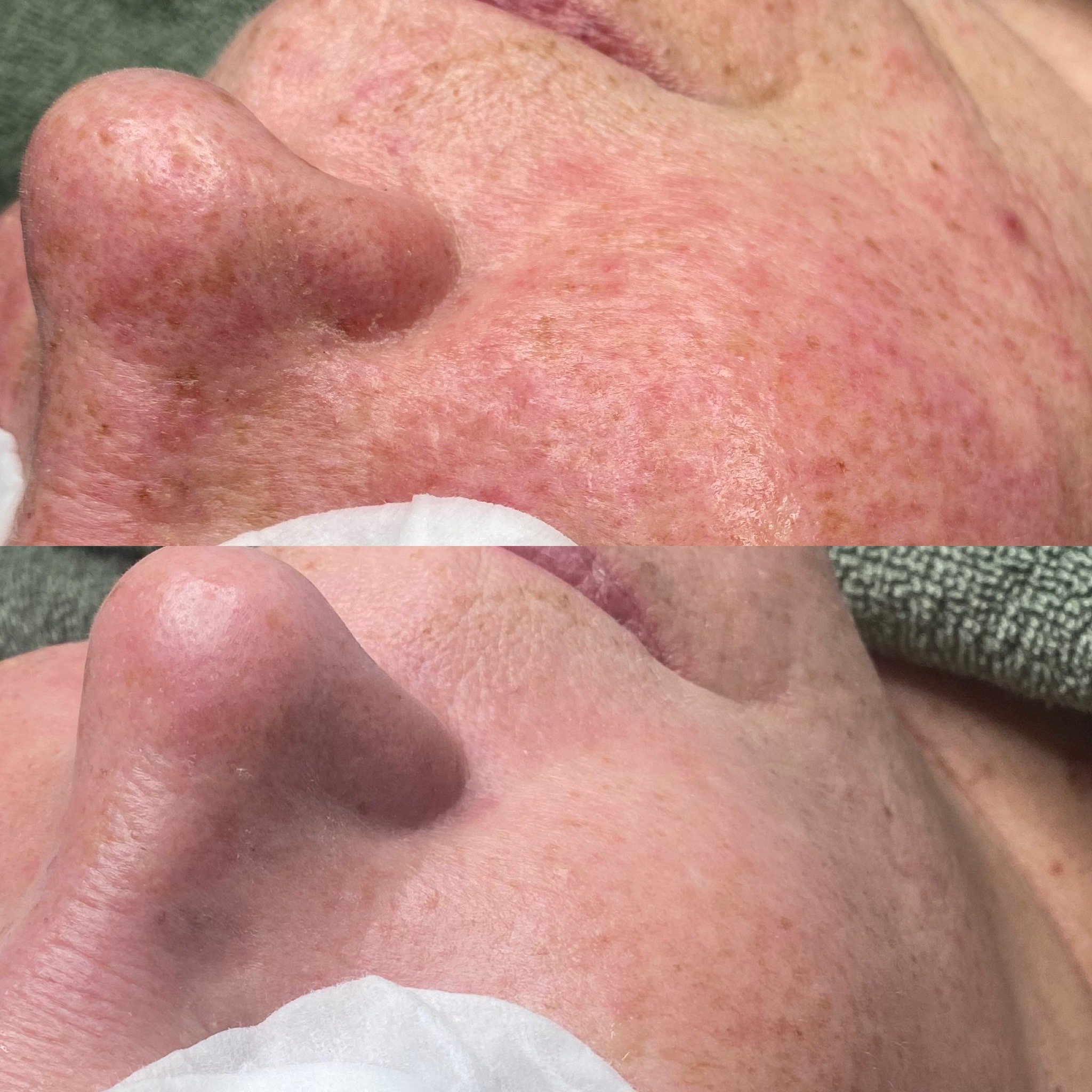 Ruusufinnin hoidon aloitus, Acne Start kauneushoitolassa.