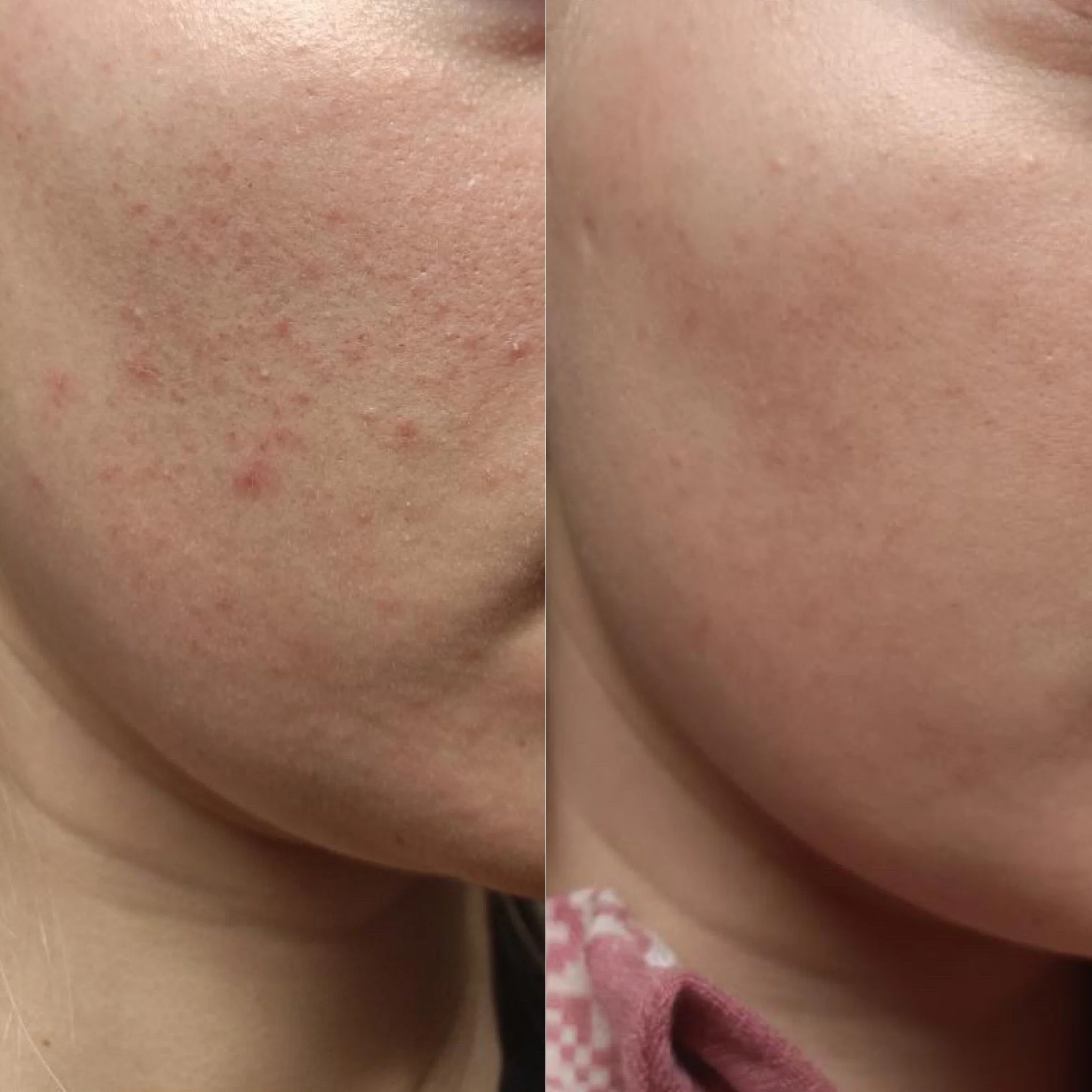 Ruusufinni, Acne Start -etäpalvelu.