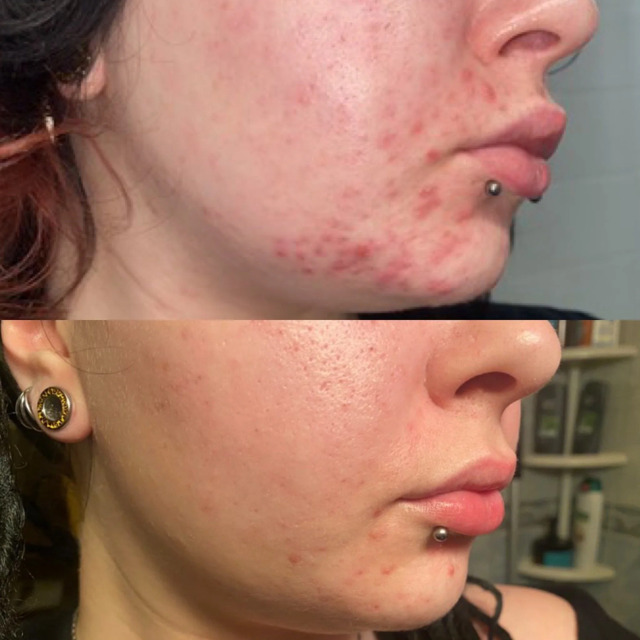 Acne Start -etäpalvelu kystisen aknen hoidon aloitus.