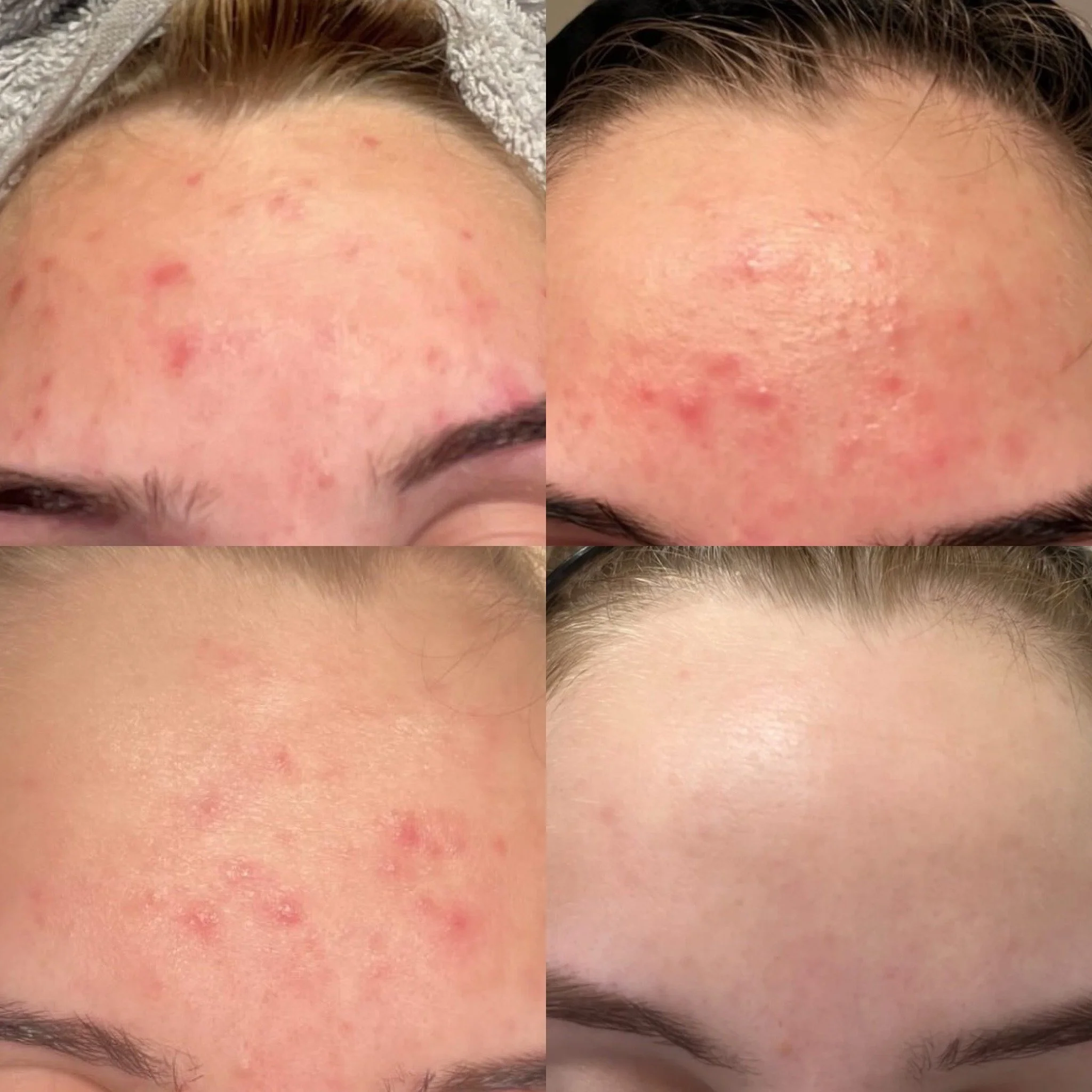 Acne Start -etäpalvelu aknen hoidon aloitus.
