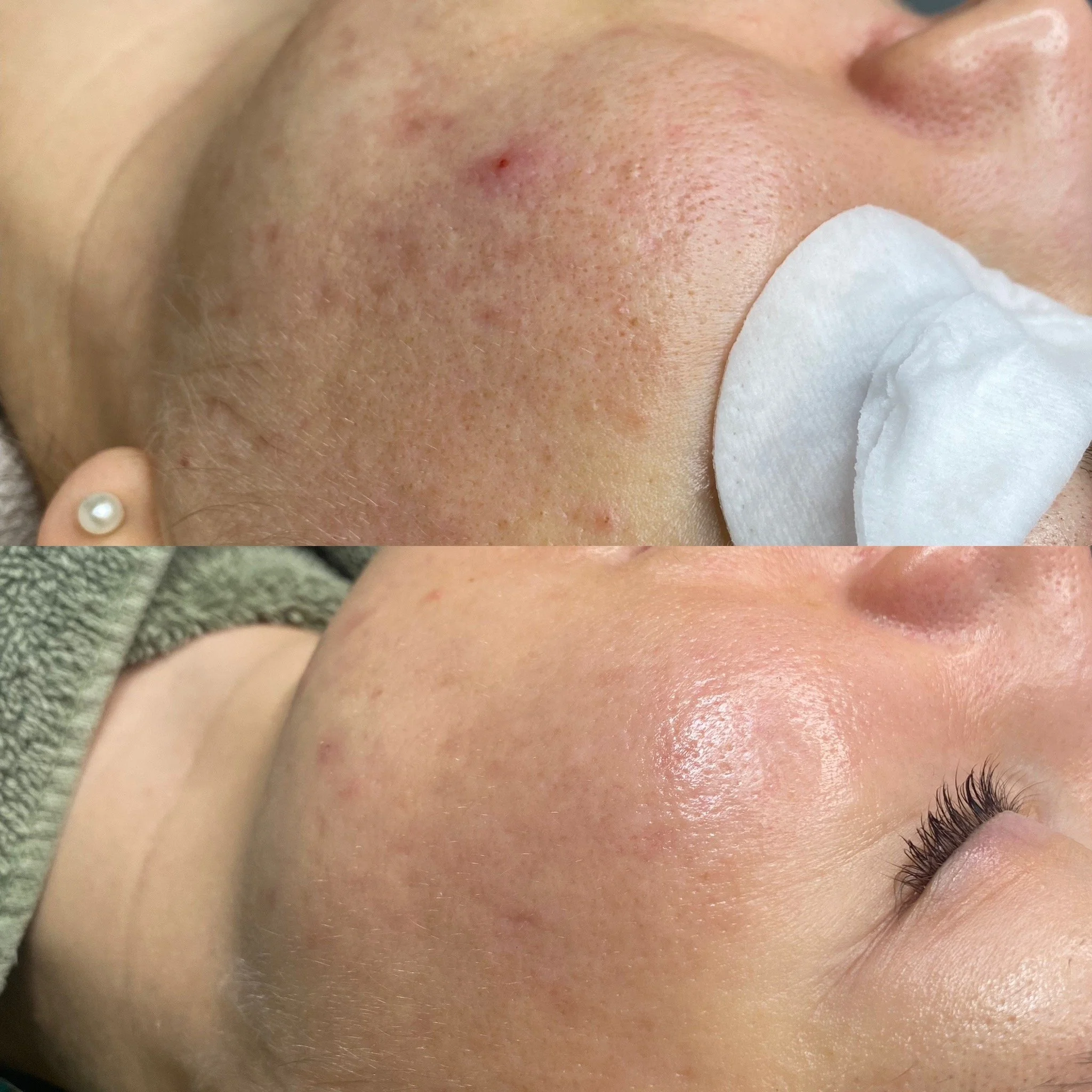 Akneen ja pigmenttimuutoksiin taipuvaisen ihon hoitotulos kahden vuoden ajalta.