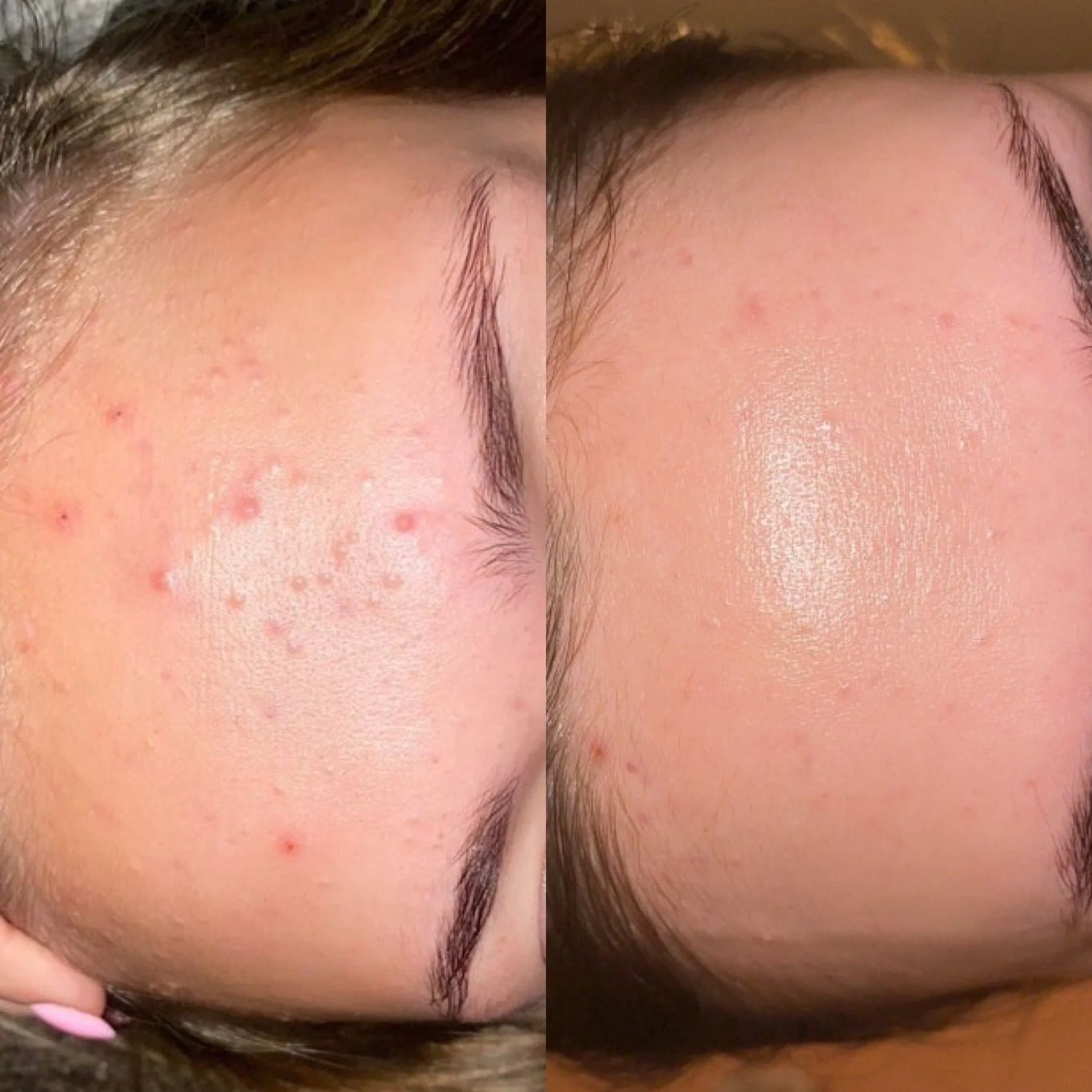 Acne Start -etäpalvelu aknen hoidon aloitus.