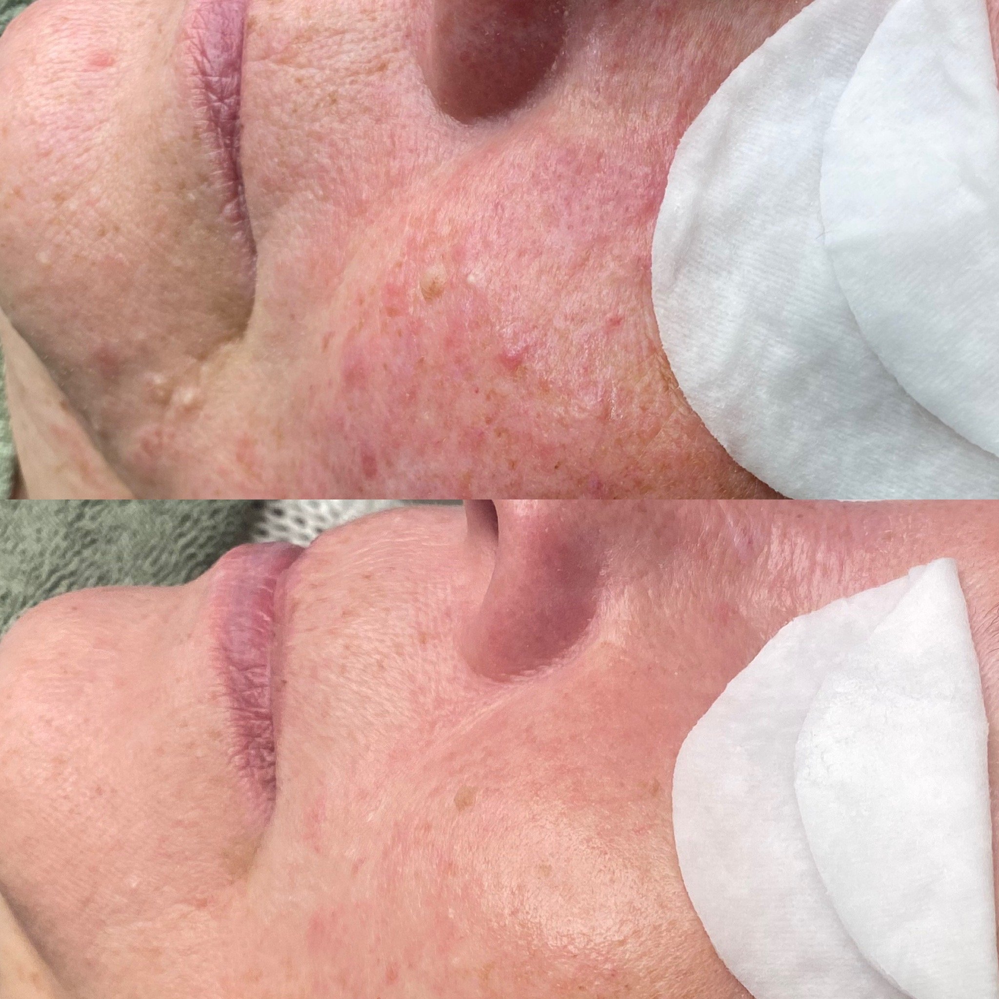 Ruusufinnin hoidon aloitus, Acne Start kauneushoitolassa.