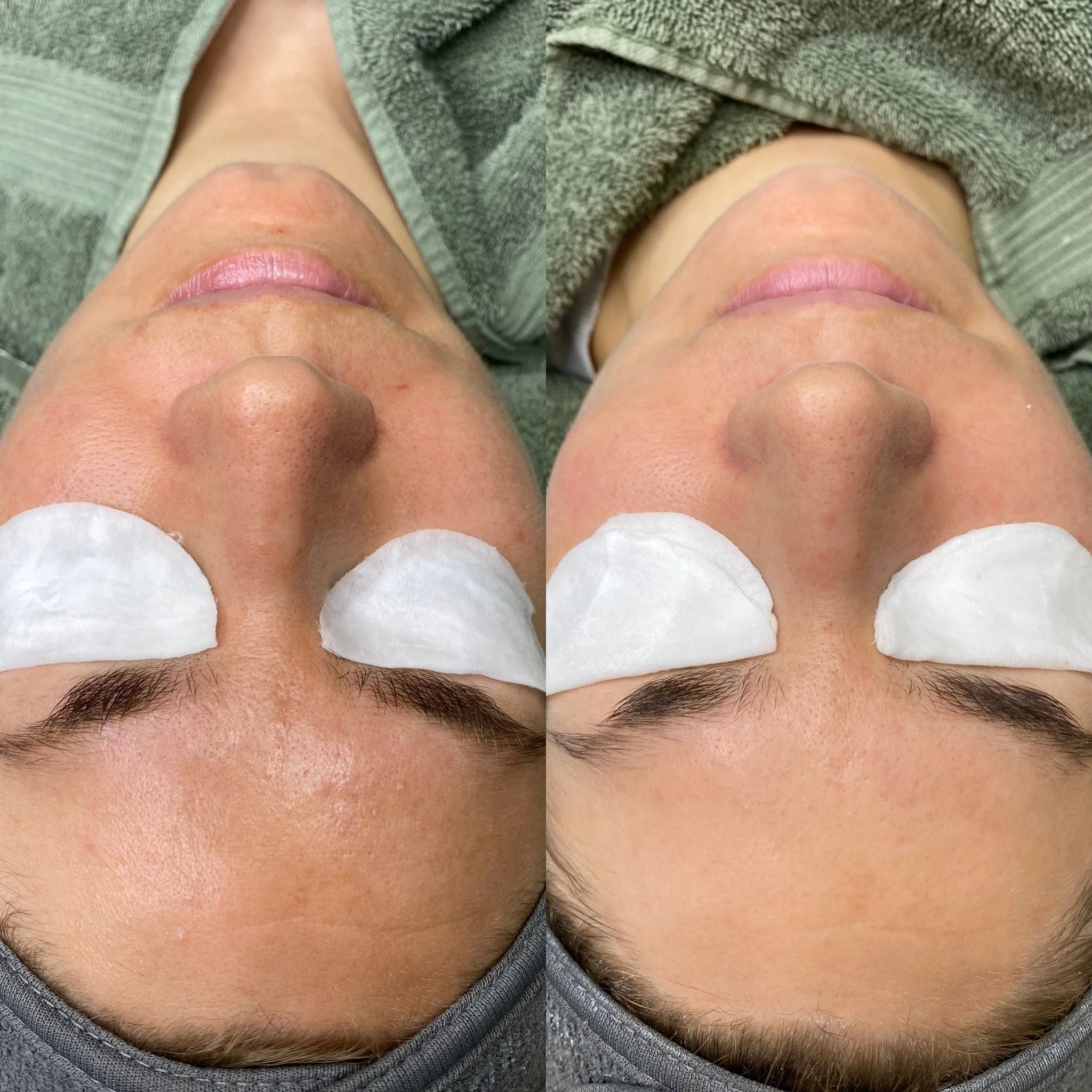 Pigmenttimuutosten hoito kauneushoitolassa.