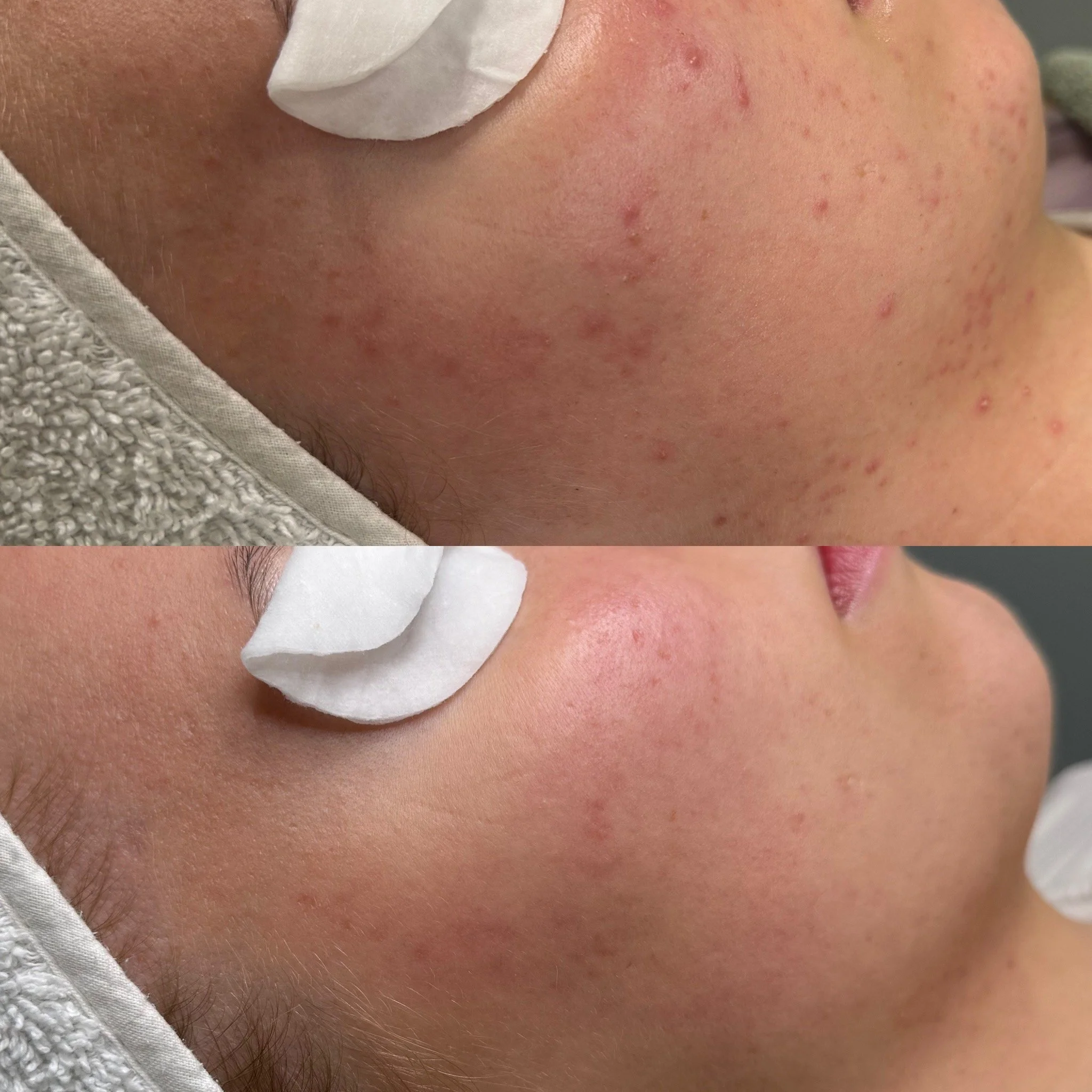 Yksi kasvohoito ja Acne Start kauneushoitolassa.