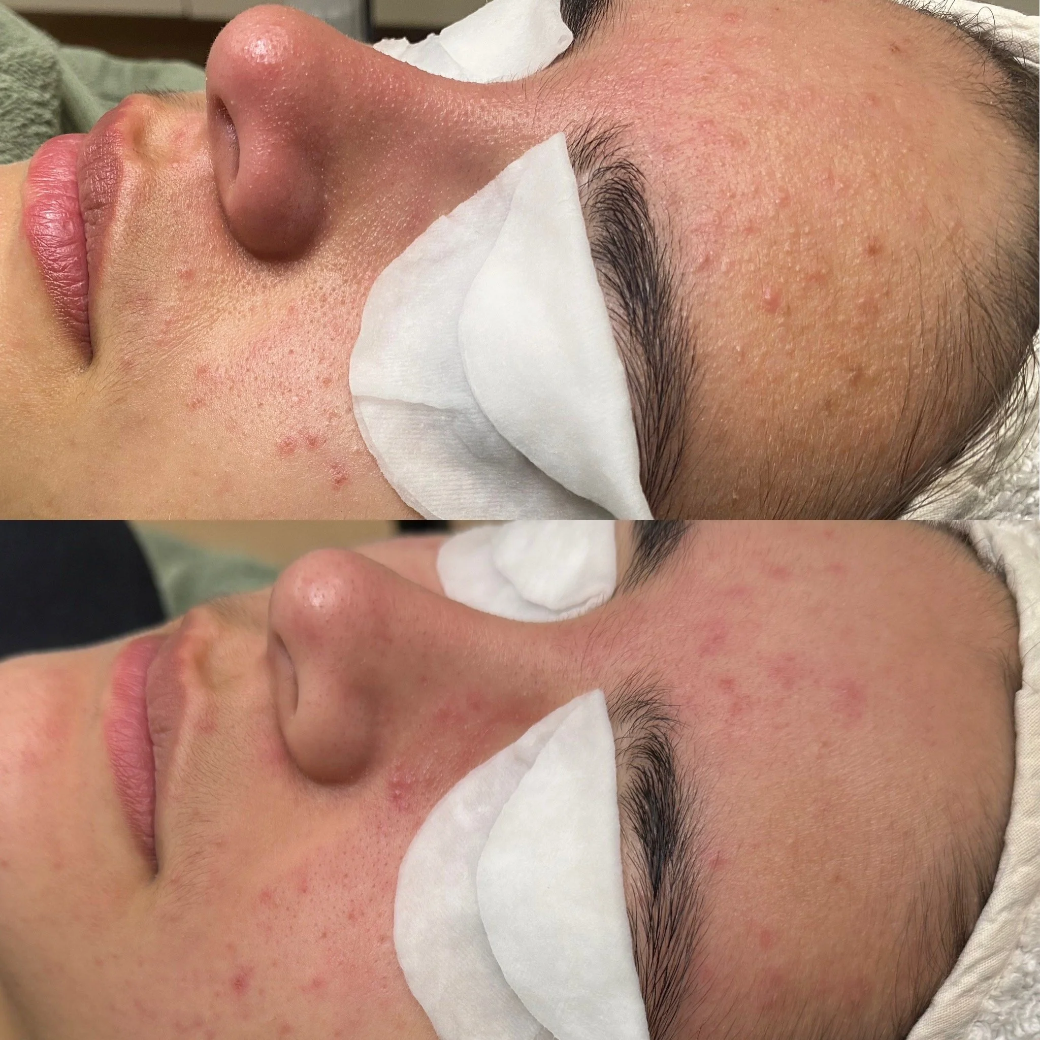 Aknen hallinta, Acne Start kauneushoitolassa.