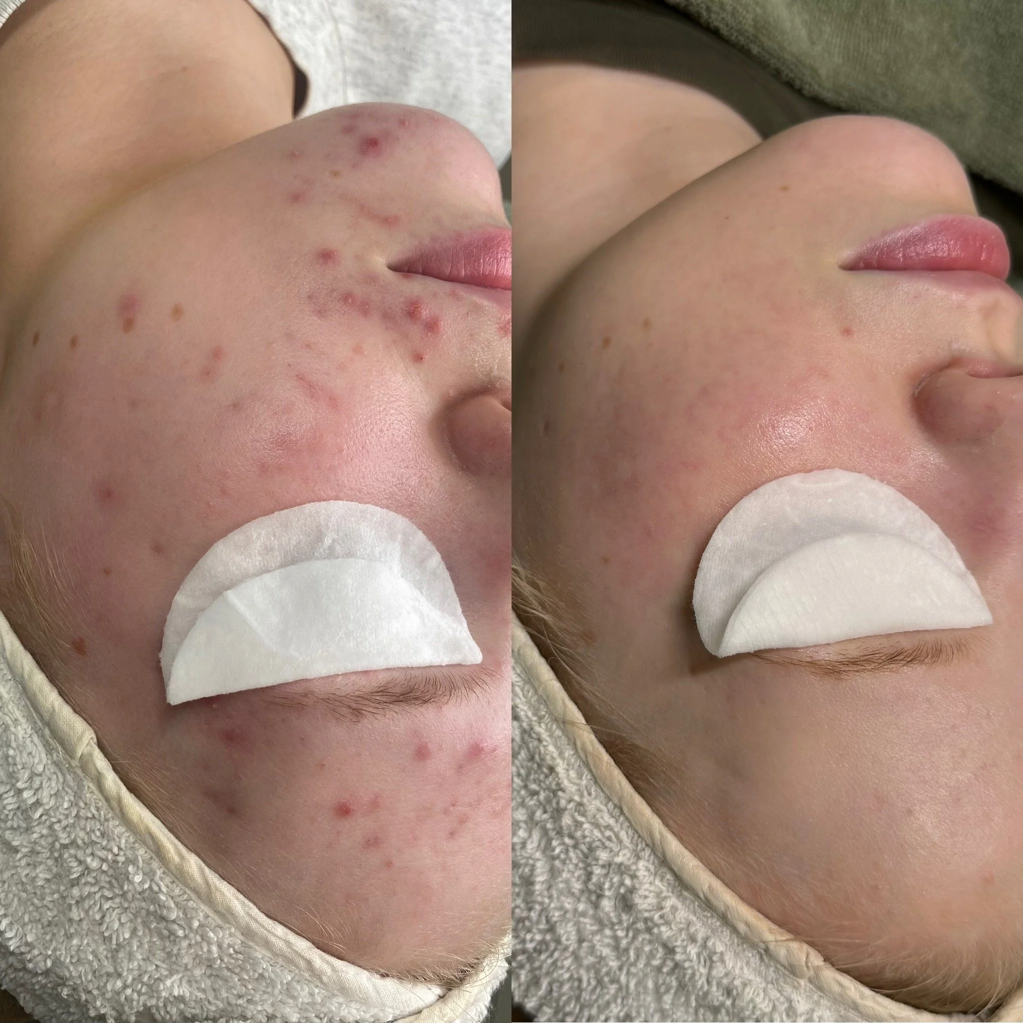 Acne Start -etäpalvelu ja sen jälkeen yksilöllinen tuotekokonaisuus kotona.