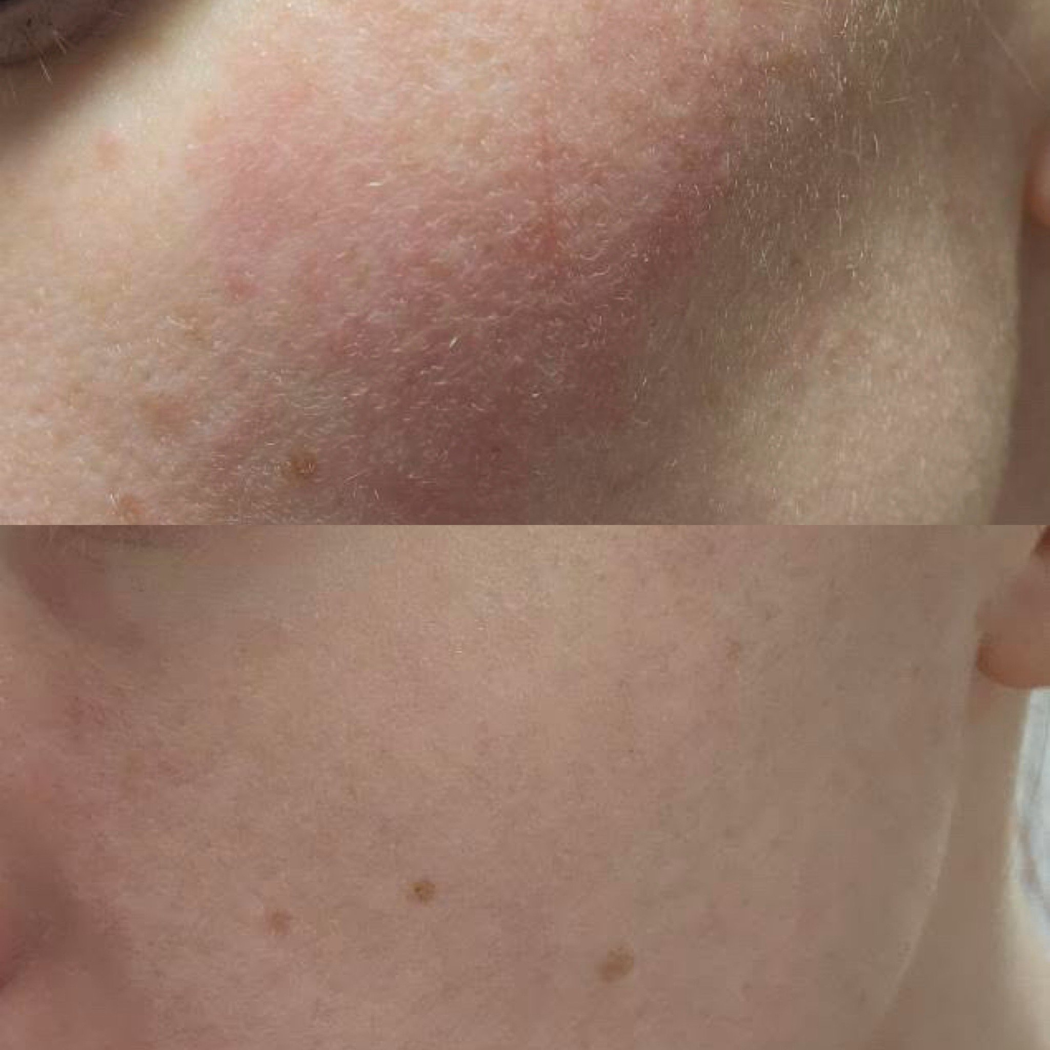 Ihottuman hoito etänä.