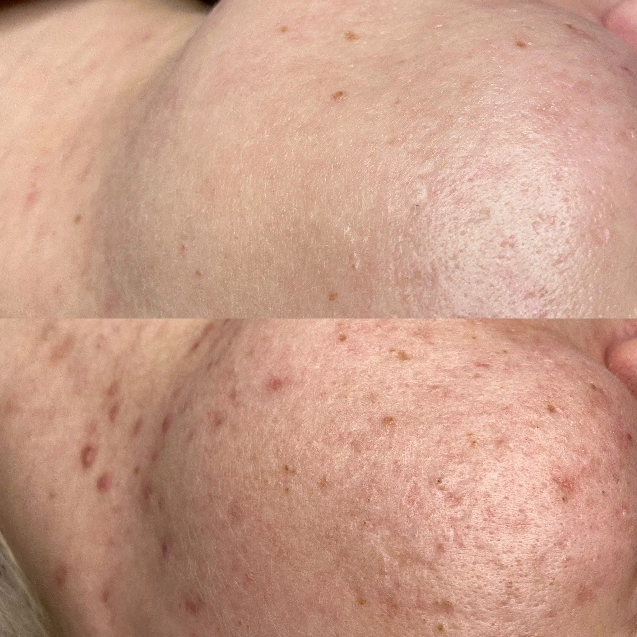 Acne Start ja kasvohoidot kauneushoitolassa.