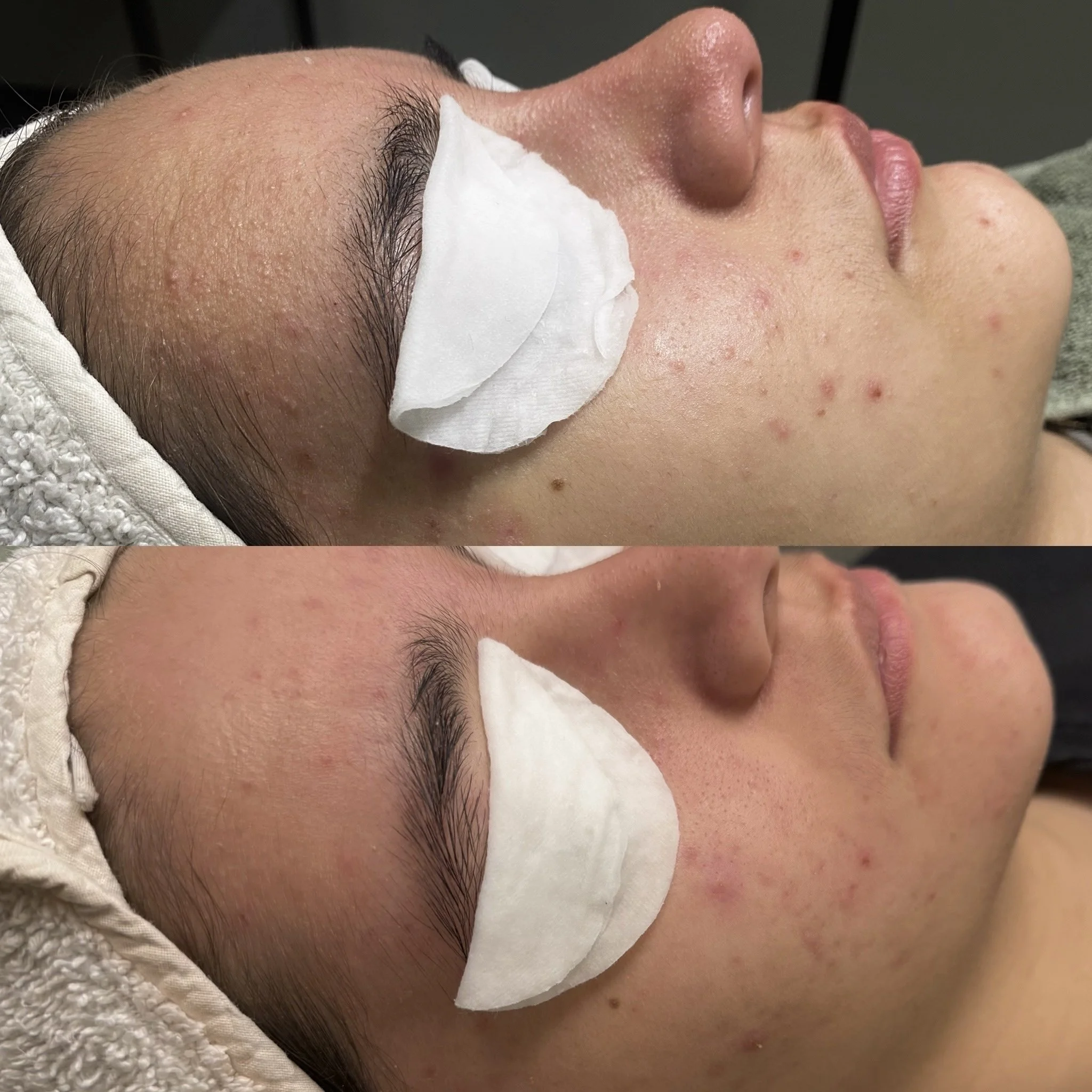 Aknen hallinta, Acne Start kauneushoitolassa.