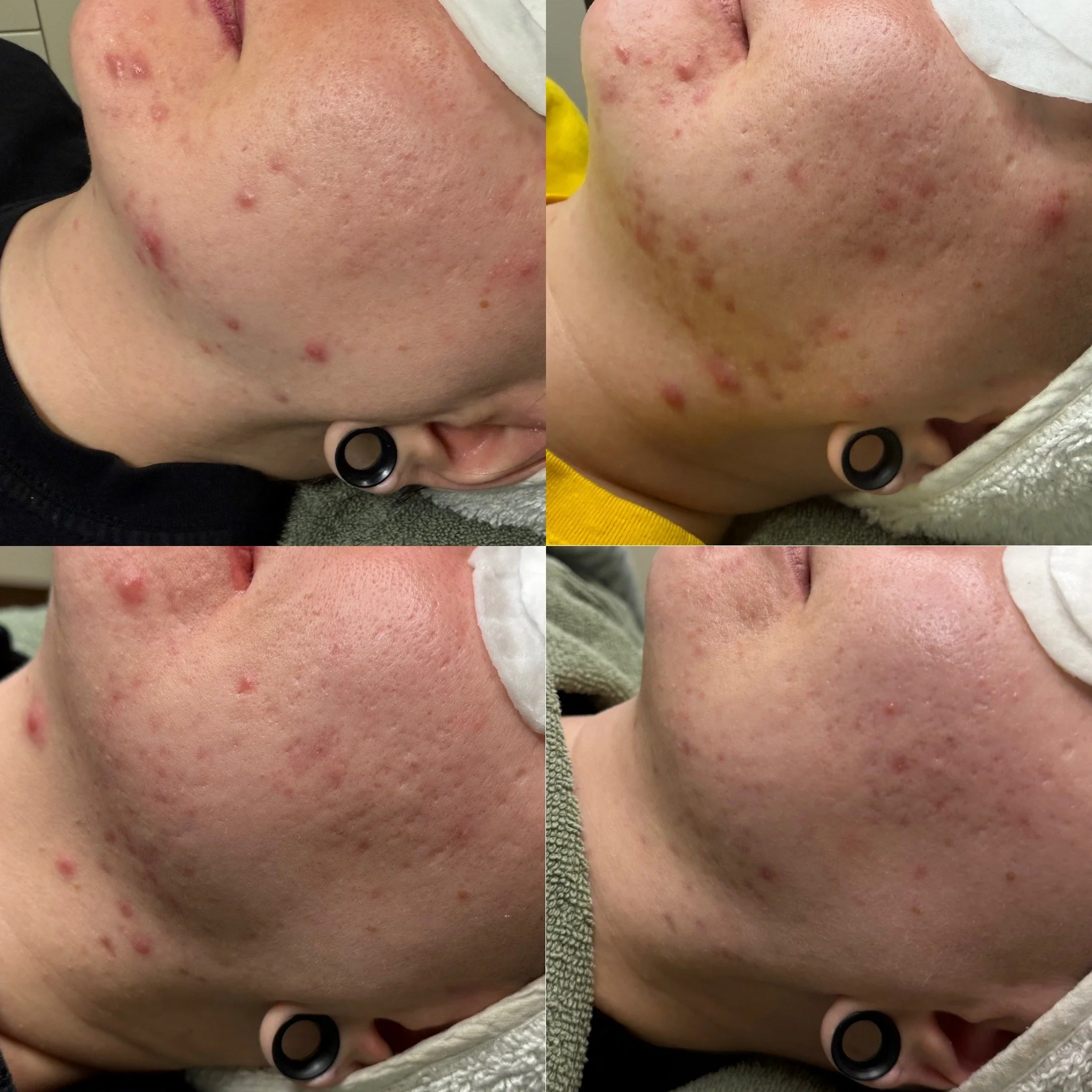 Acne Start ja 4x AHA Advanced Peel KauneuSkin kauneushoitolassa
