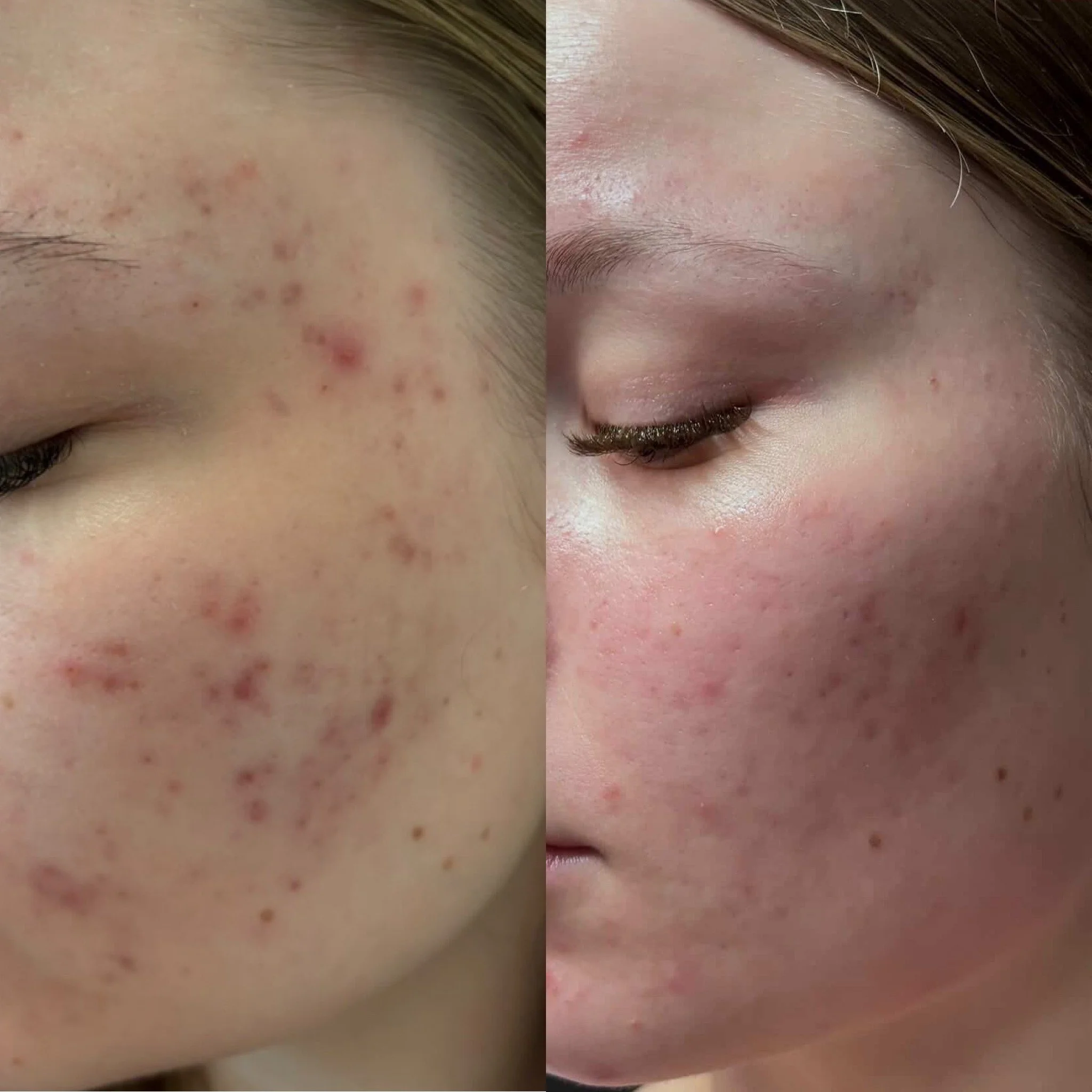 Aknen jättämien PIE-läiskien hoitoa etänä kotona.