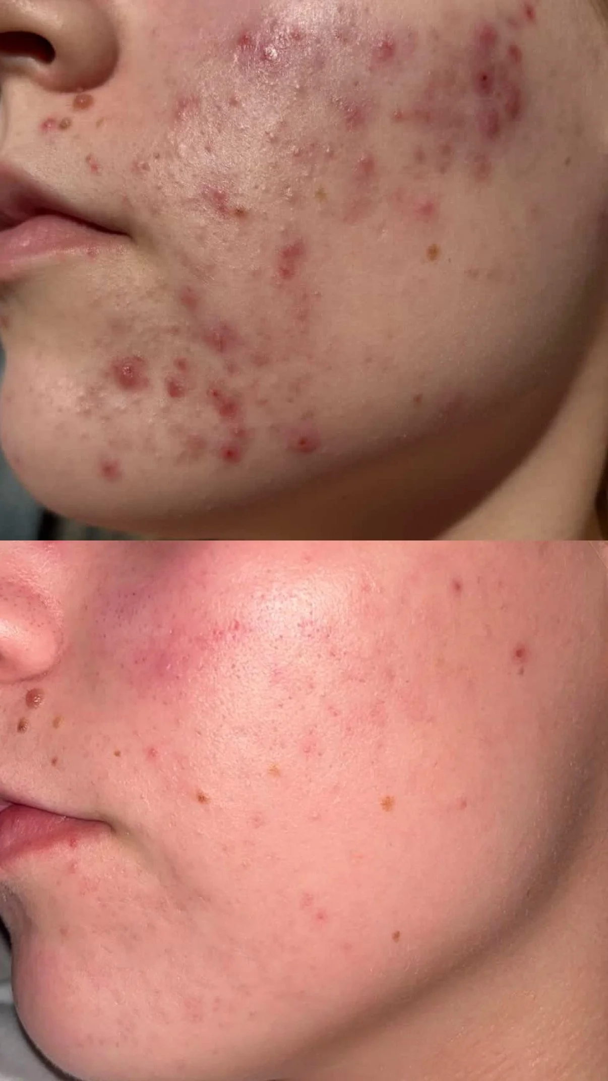 Acne Start -etäpalvelu.