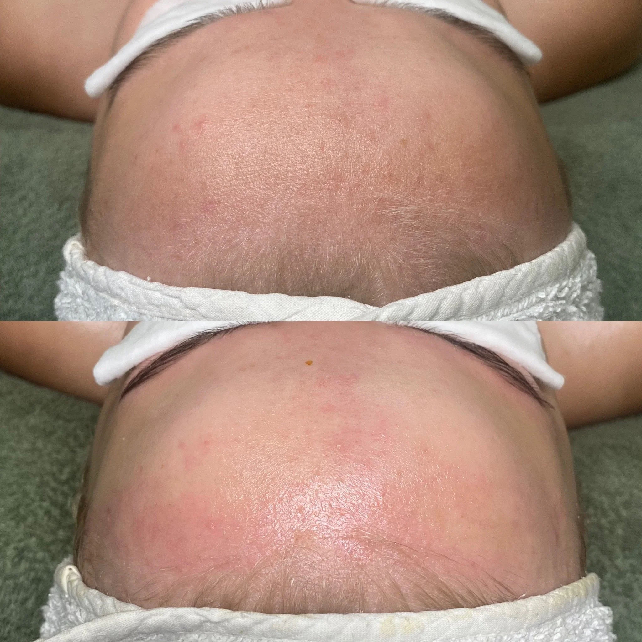 Yksi BiON Signature Expert kasvohoito kesän aikana syntyneeseen pigmenttimuutokseen otsalla.