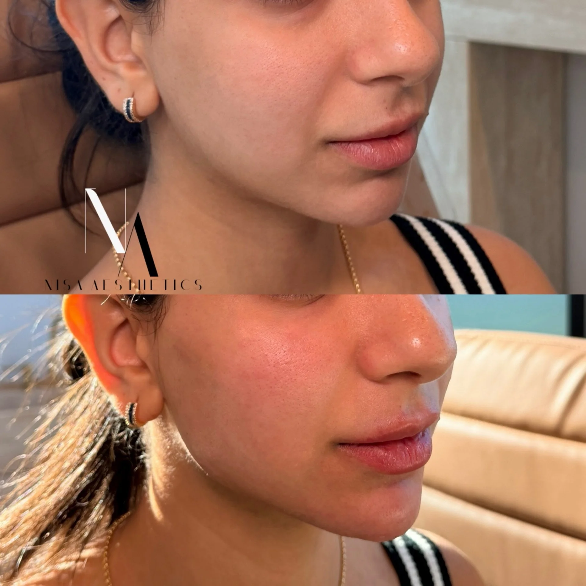 . 
A little chisel &amp; height to start the day 📐
📍under-eyes, cheek, lips, jawline, chin 🤎
Not a lot. Just enough.

#FullFaceRejuvenation #FacialBalancing #AestheticNurse #NaturalResults #calabasas