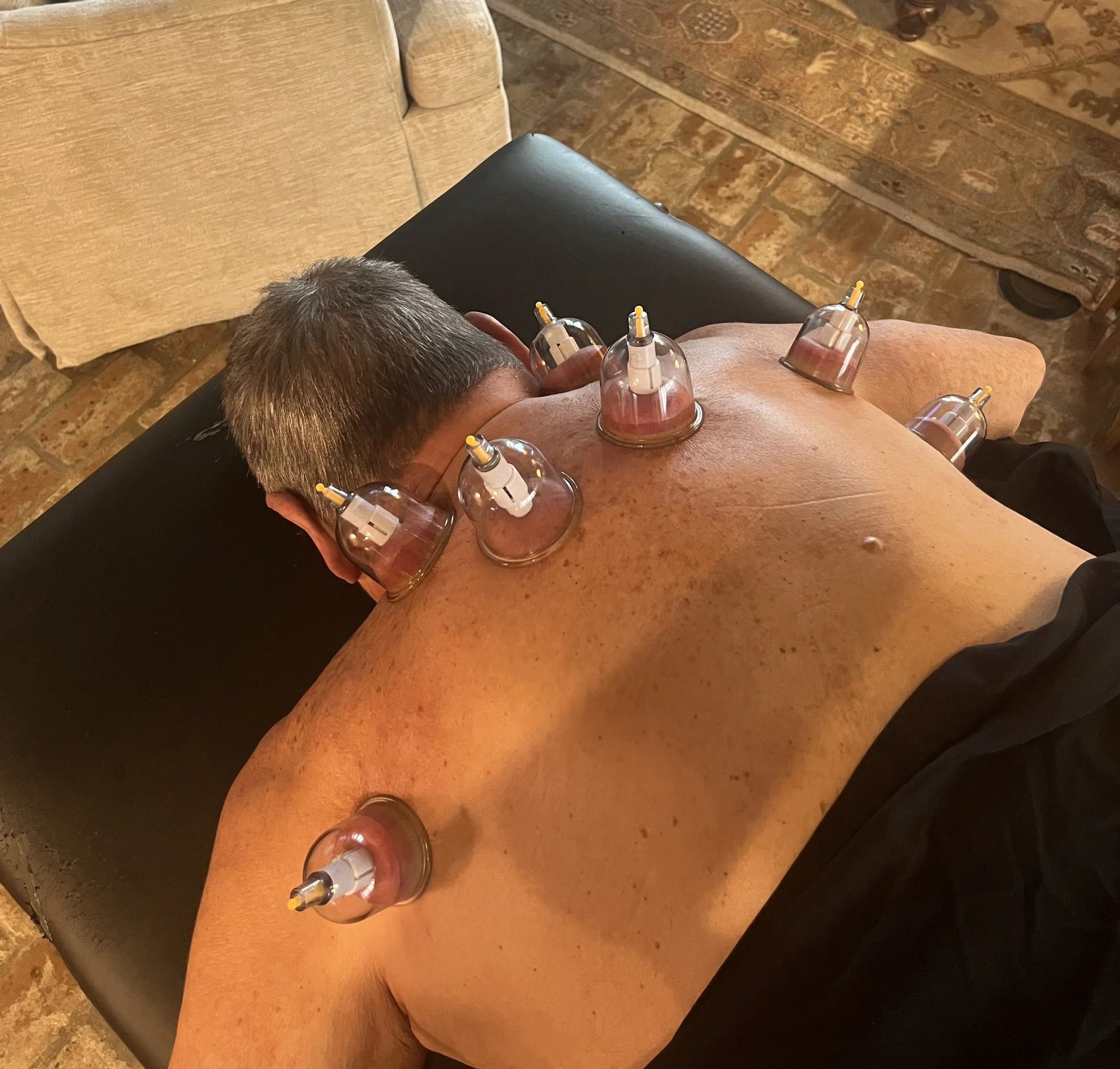 Person receiving cupping therapy with multiple cups placed on their back while lying face down on a massage table.