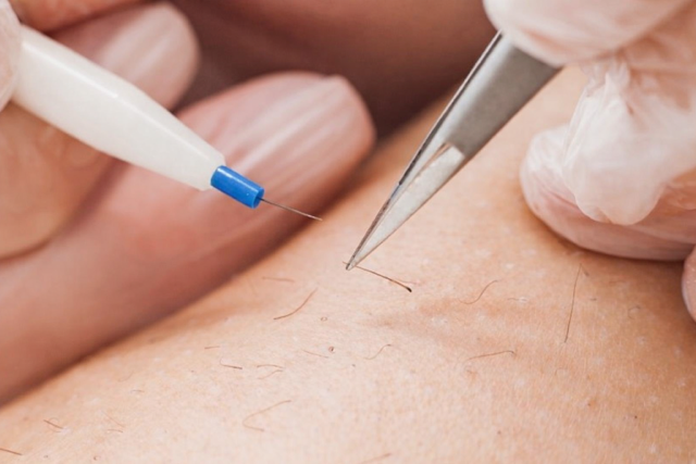 Close-up of a person having electrolysis for hair removal.