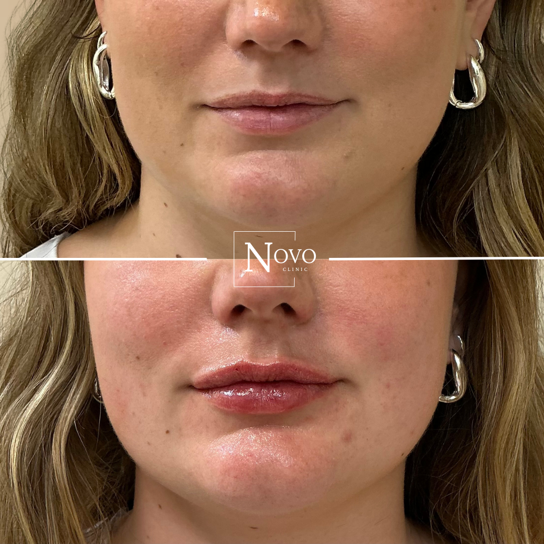 Natural lip filler results by doctor-led aesthetic clinic in Essex