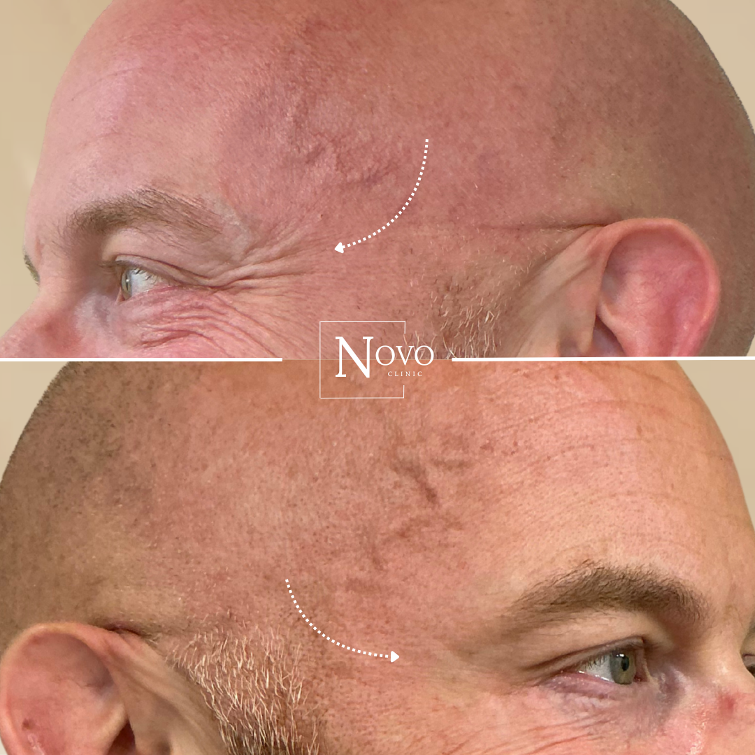 Forehead wrinkle reduction before and after.