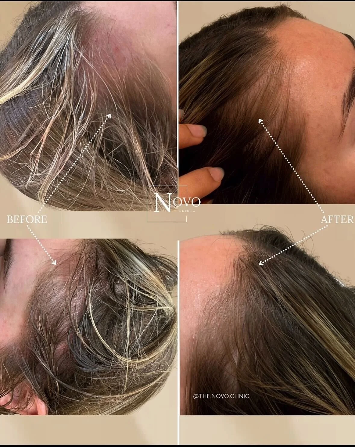 Before and after images of a person's scalp and hair, showing hair restoration treatment results. The 'before' images depict thinning hair with visible scalp, while the 'after' images show thicker, fuller hair with reduced scalp visibility. The images are labeled with 'before' and 'after' and include a logo of THE NOVO CLINIC.