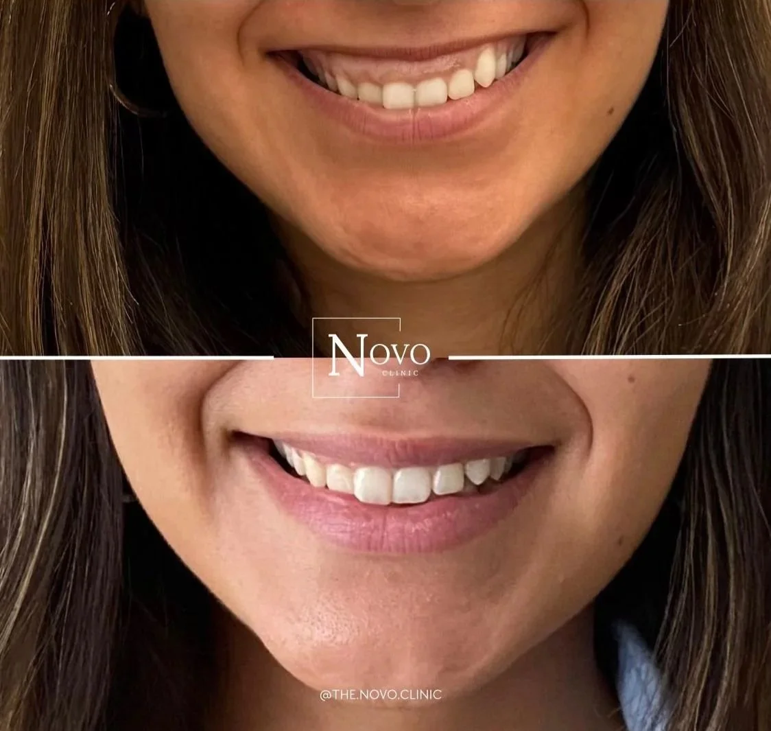 Before and after gummy smile treatment
