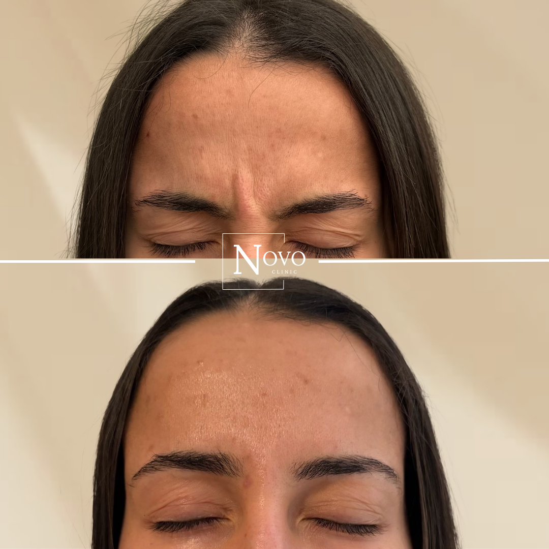 Anti-wrinkle injection results at The Novo Clinic in Chelmsford