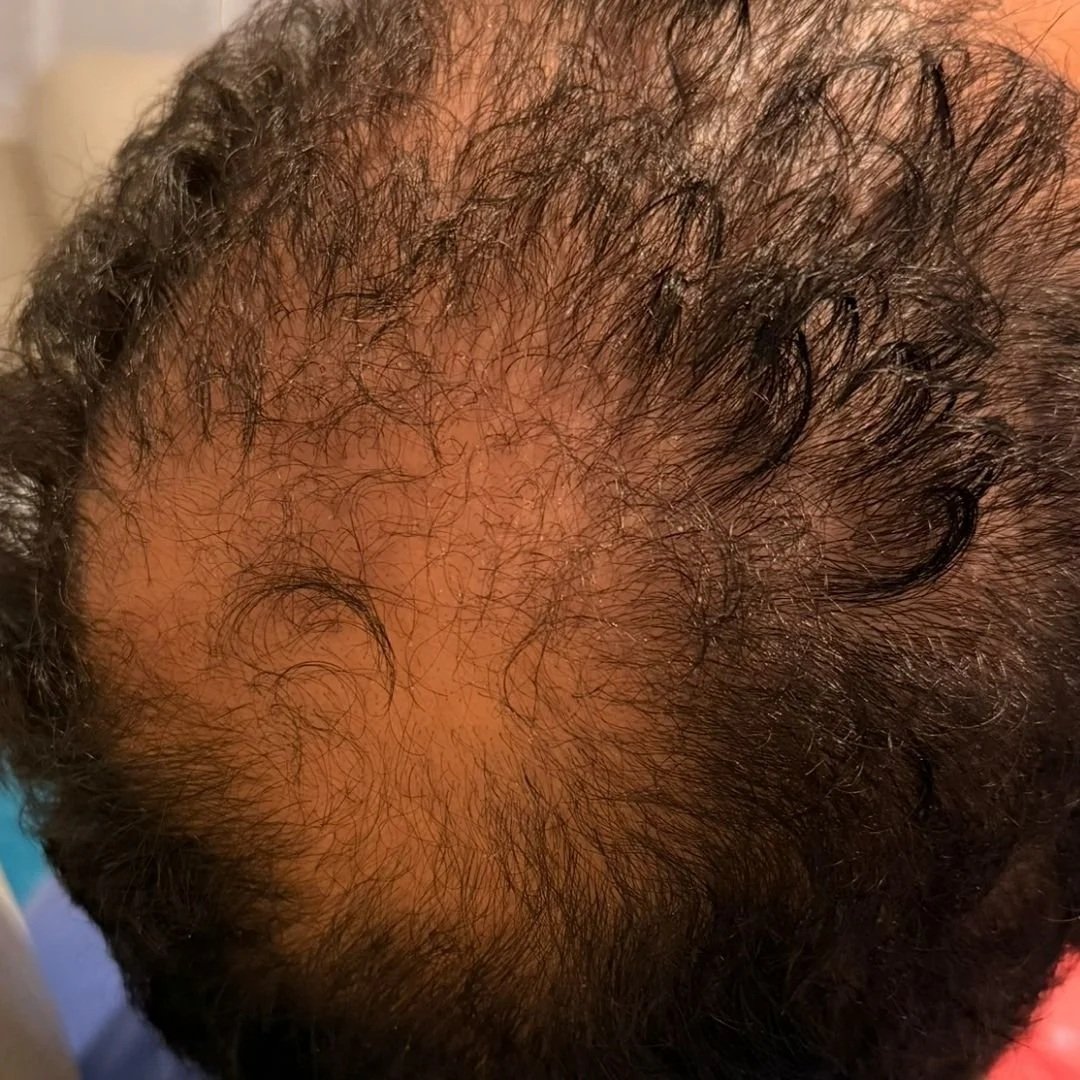 After PRP for hairloss