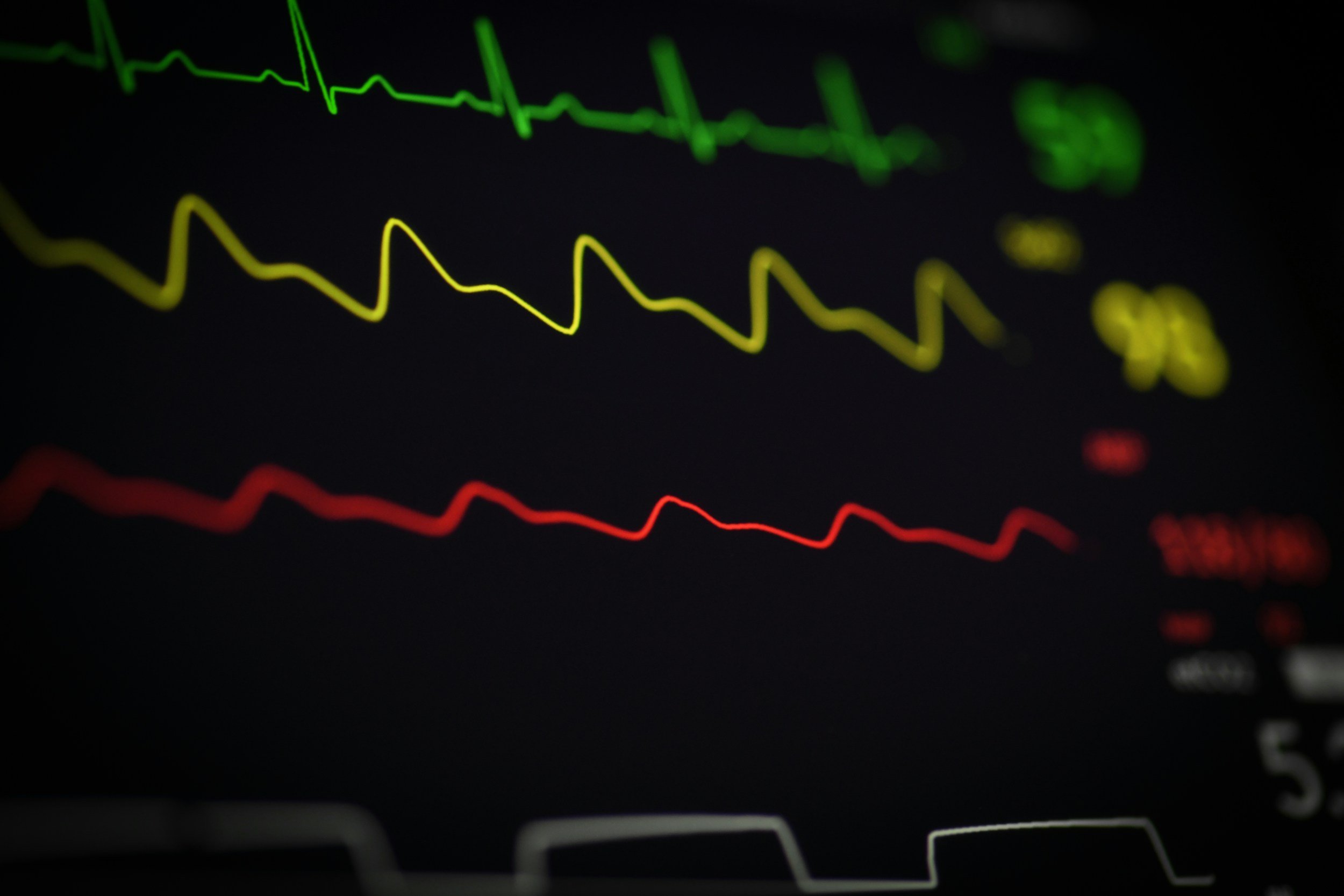Close-up of an electrocardiogram (ECG) monitor with green, yellow, and red waveforms representing heart activity.