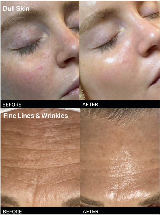 Before and After images for Hydrafacial treatment. Women's faces show less wrinkles and blemishes.