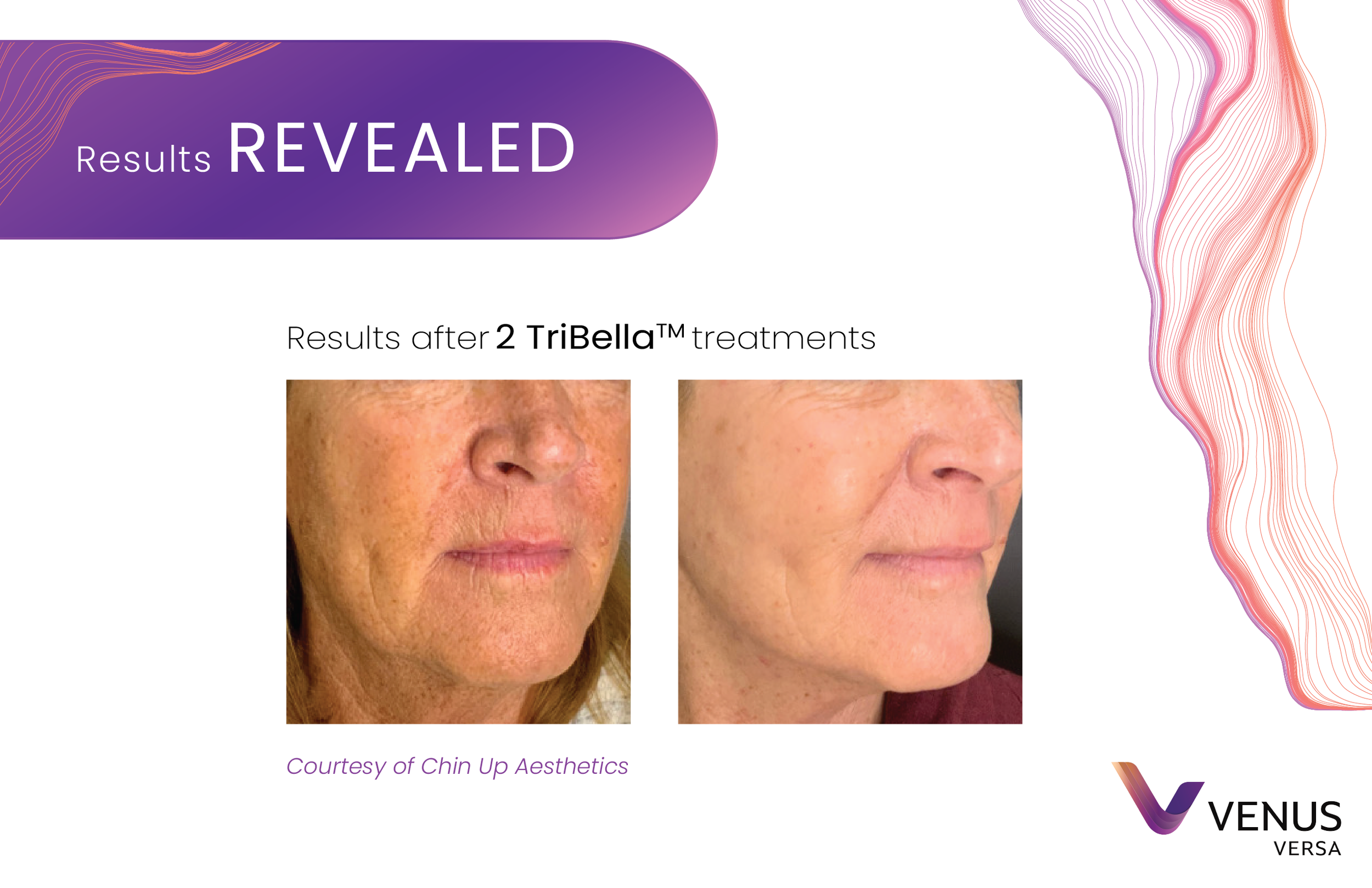 Before and after for Venus Versa TriBella treatment. Woman's lower face shows less wrinkles.