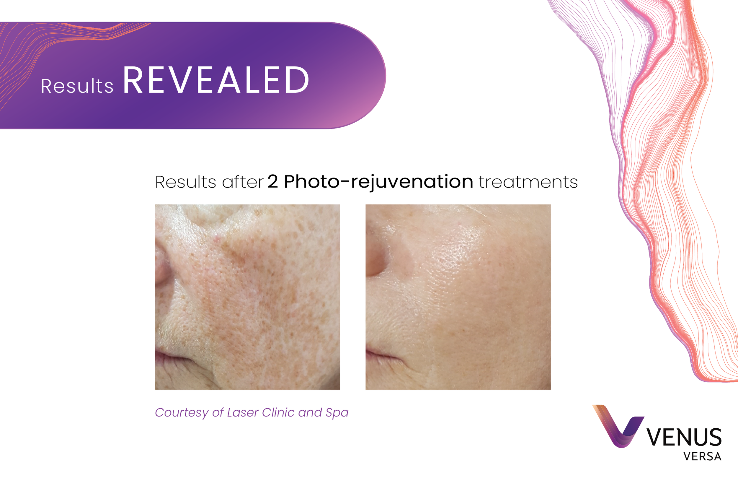 Before and after image for venus versa photo-rejuvenation photo facial treatment. Woman's cheek shows less wrinkles and spots.