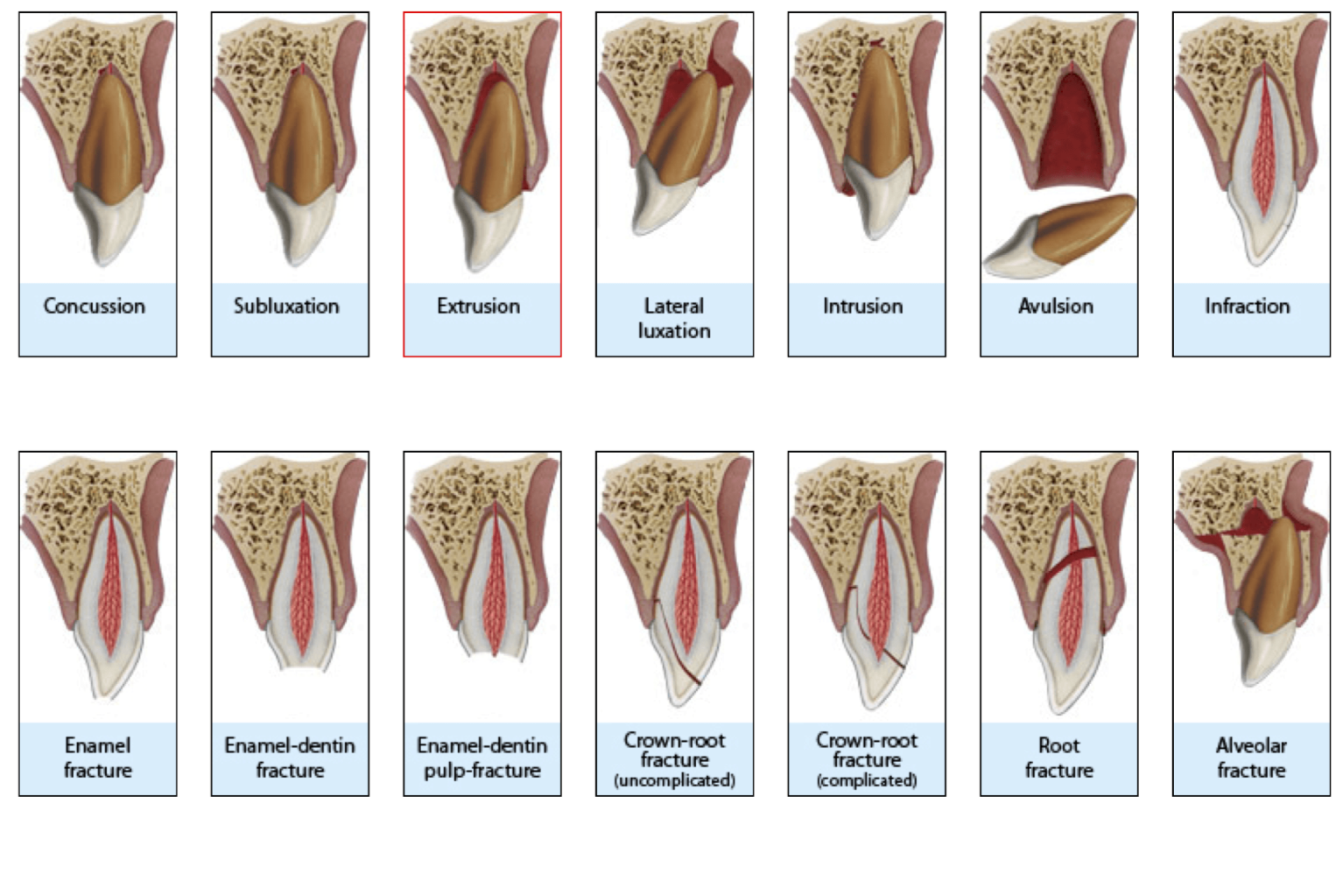 A diagram of tooth fractures showing various types such as concussion, Subluxation, extrusion, lateral luxation, intrusion, avulsion, and infraction, with detailed cross-sections illustrating different root and crown fractures.