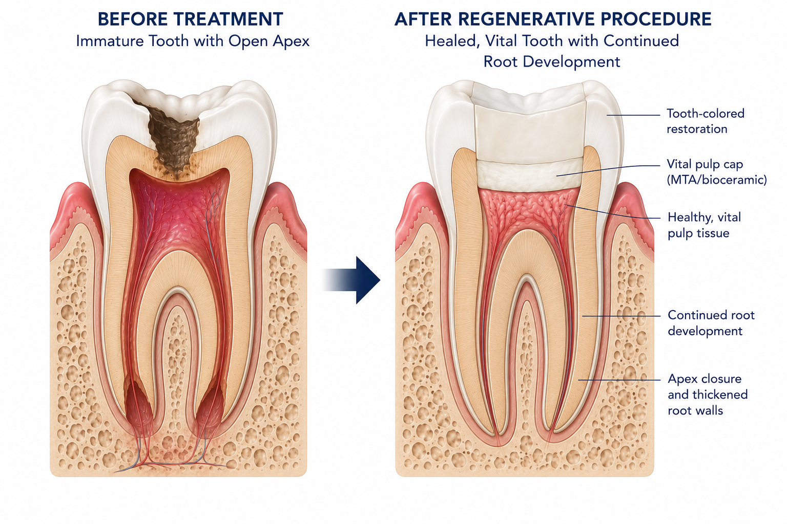 Comparison of a tooth before and after regenerative treatment. Before treatment: an immature tooth with an open apex and damaged tissue. After treatment: a healed, vital tooth with a tooth-colored restoration, a vital pulp cap, healthy pulp tissue, continued root development, and closed, thickened root walls.