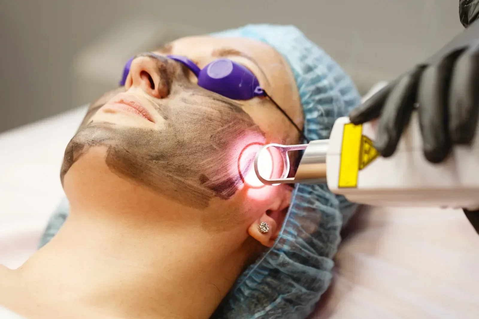 Woman with charcoal mask receiving laser treatment from esthetician