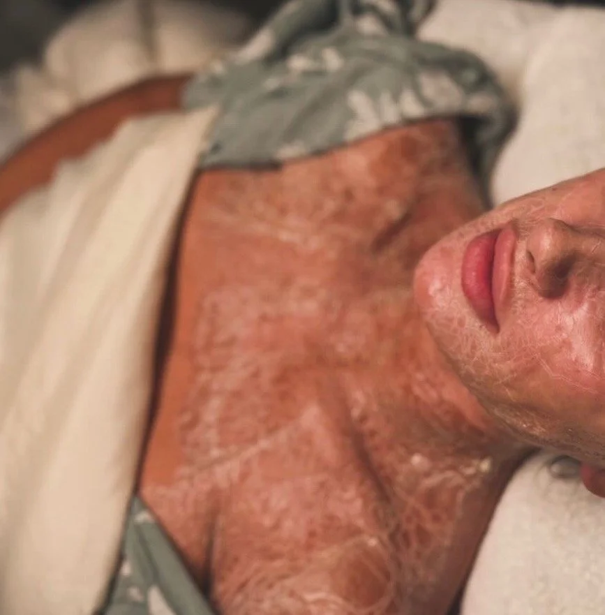 Close-up of a person's face with lips slightly parted, and a person's upper body with reddish skin and visible skin issues on a bed with white sheets.