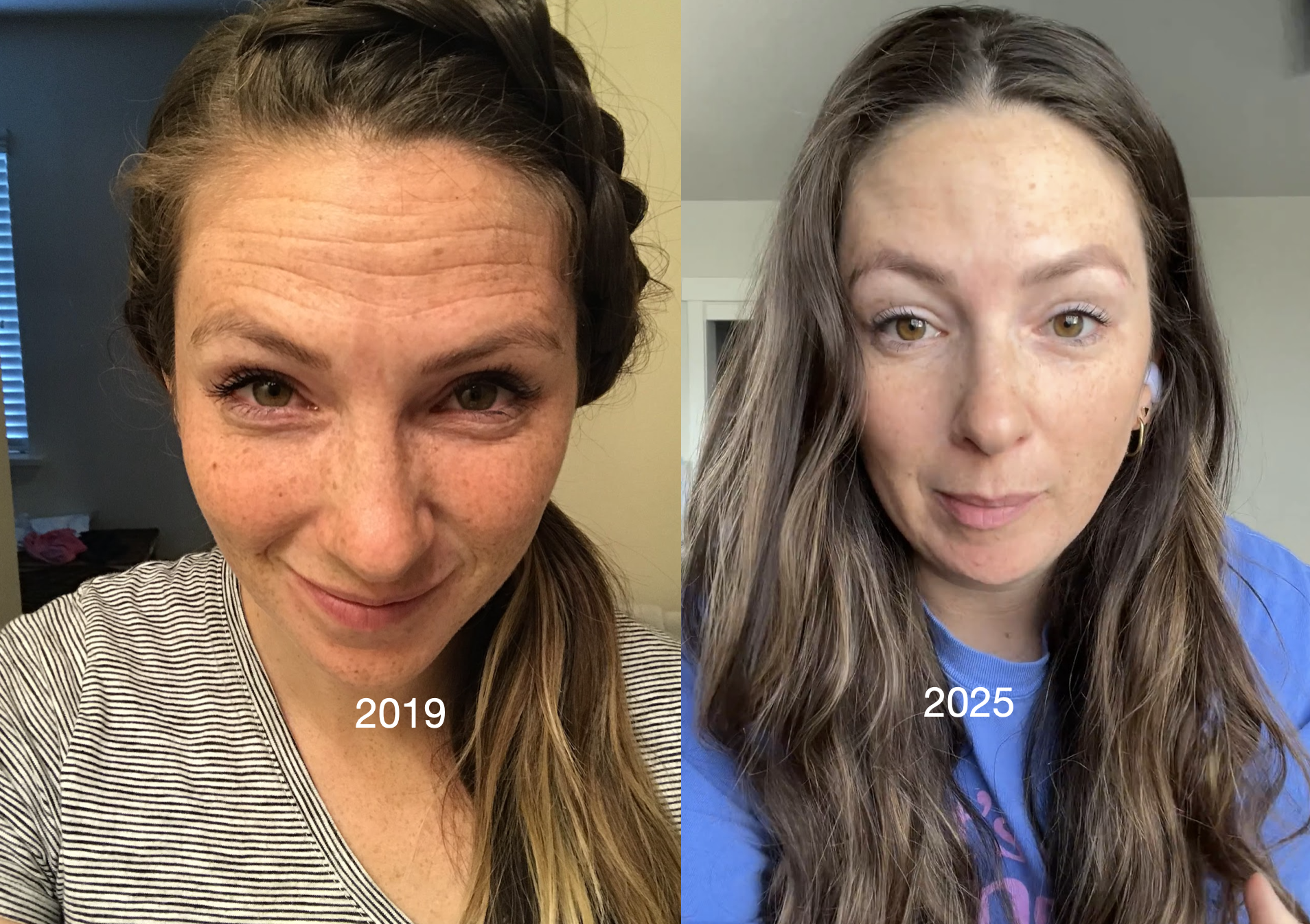 Natural Botox alternative that actually works (with pics to prove!)