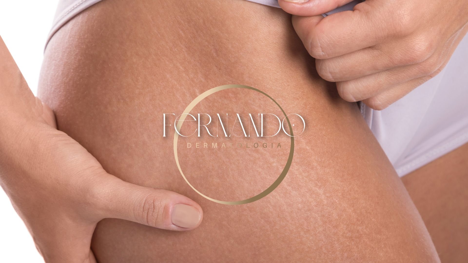 Corpo em Dia: Tudo o que você precisa saber para vencer as estrias (e as novidades para 2026!)