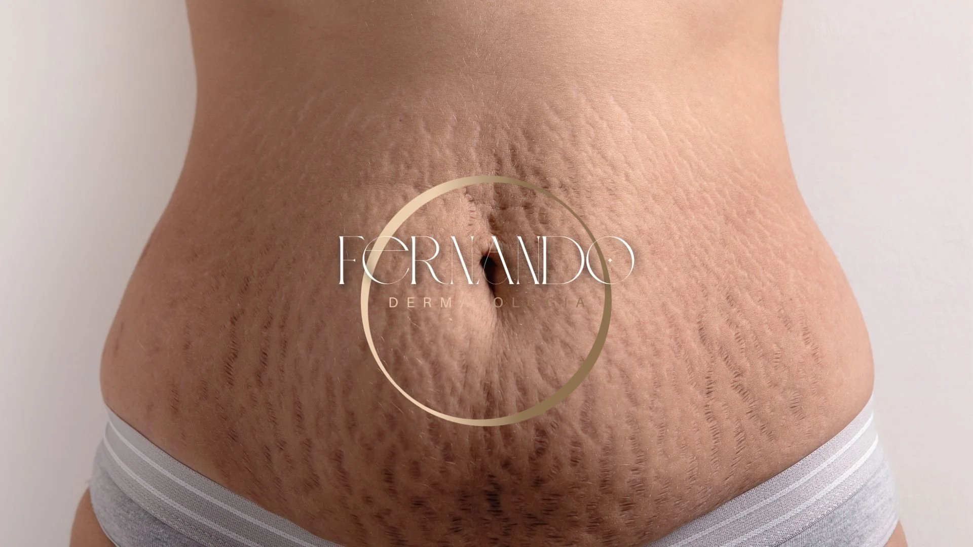 Abdomen de mãe de filho com a apresentando estrias rubras no abdomen irei