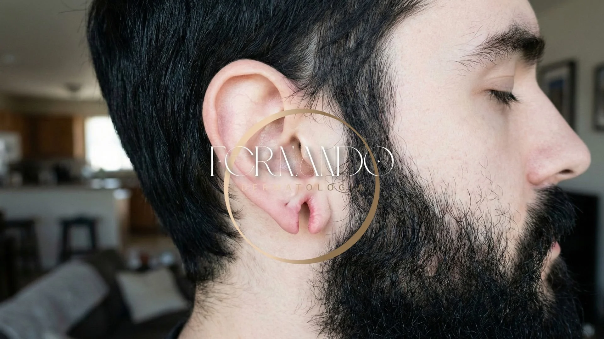 Homem de perfil mostrando uma fenda de orelha completa.