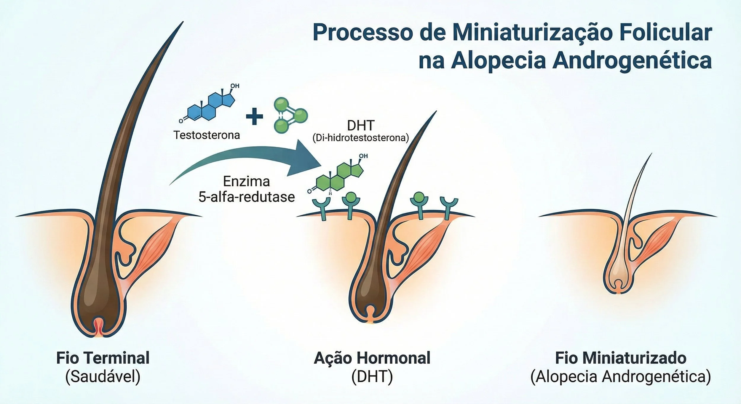 Procedo de Miniaturização Folicular na Alopecia Androgenética - Dr. Fernando Henrique Canhoto Alves, dermatologista titular da Sociedade Brasileira de Dermatologia e da Sociedade Brasileira de Cirurgia Dermatológica, São Paulo-SP