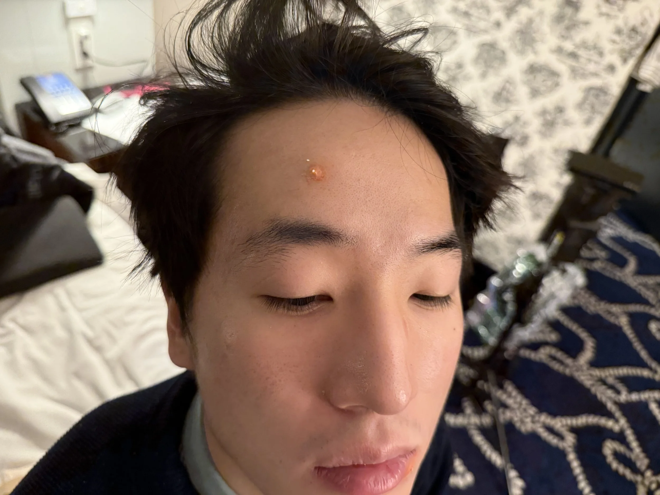 Pimples for "The Delegate" by Morgan Bramwell