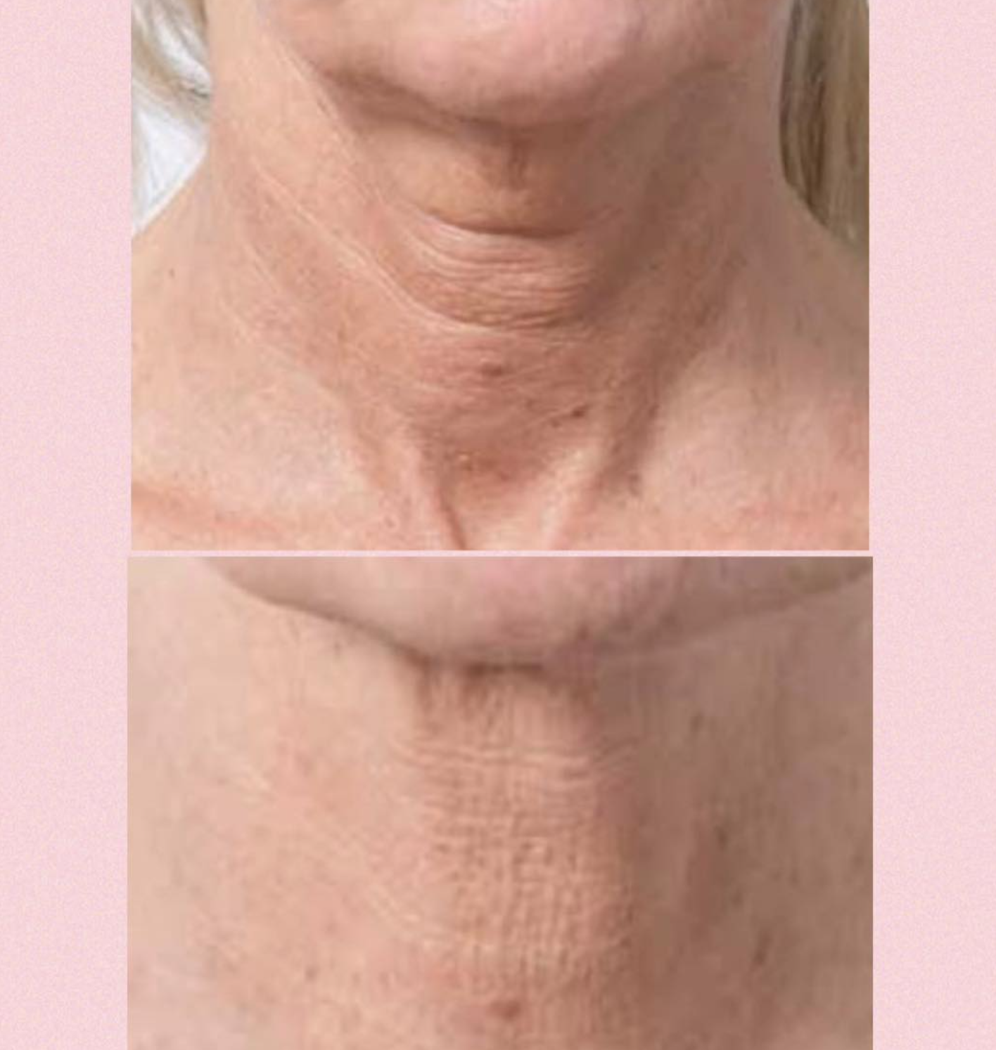 Profhilo behandling hos Klinik Skin Rehab i Charlottenlund