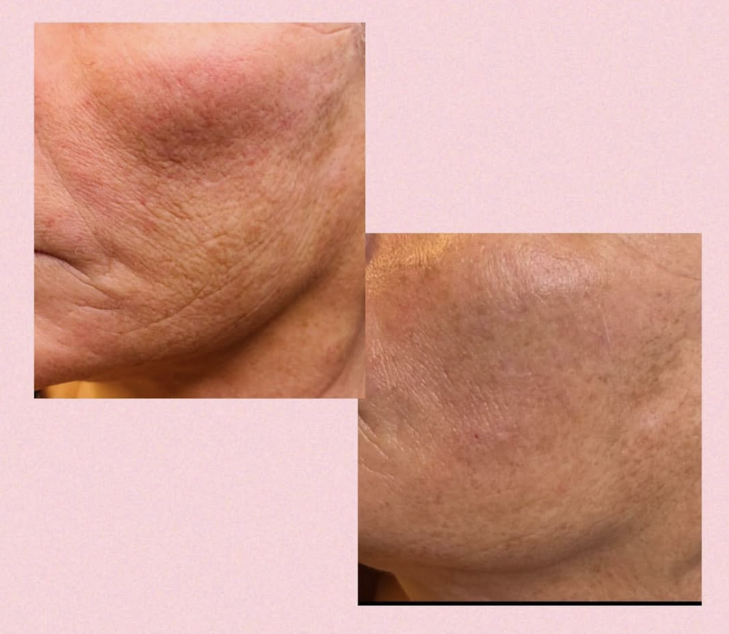Skinbooster behandling hos Klinik Skin Rehab i Charlottenlund