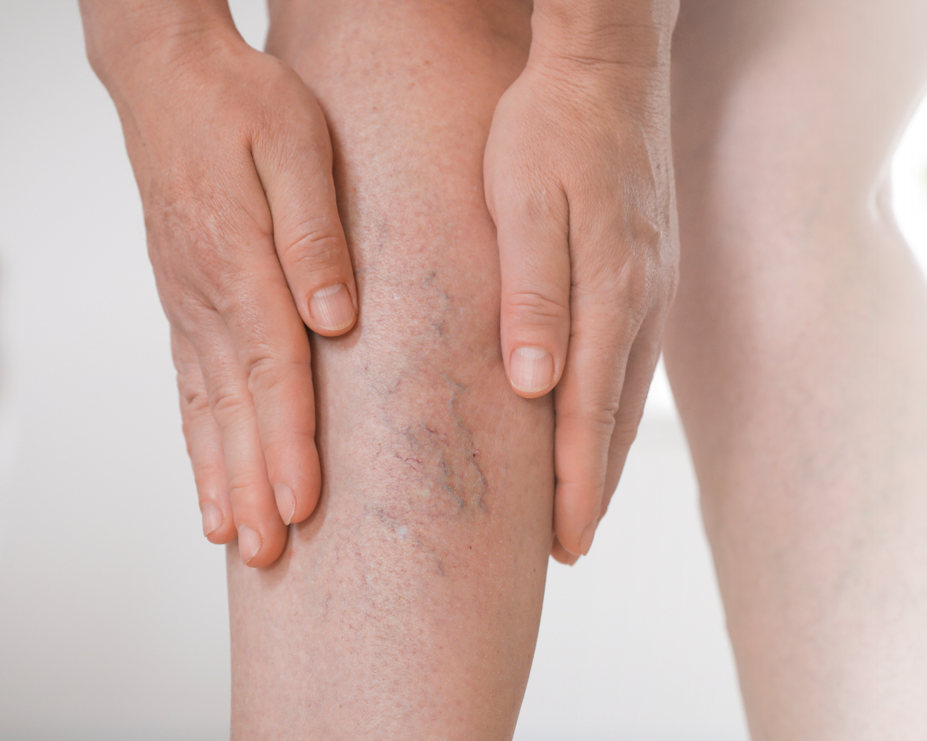 Fjernelse af karsprængninger hos Klinik Skin Rehab i Charlottenlund