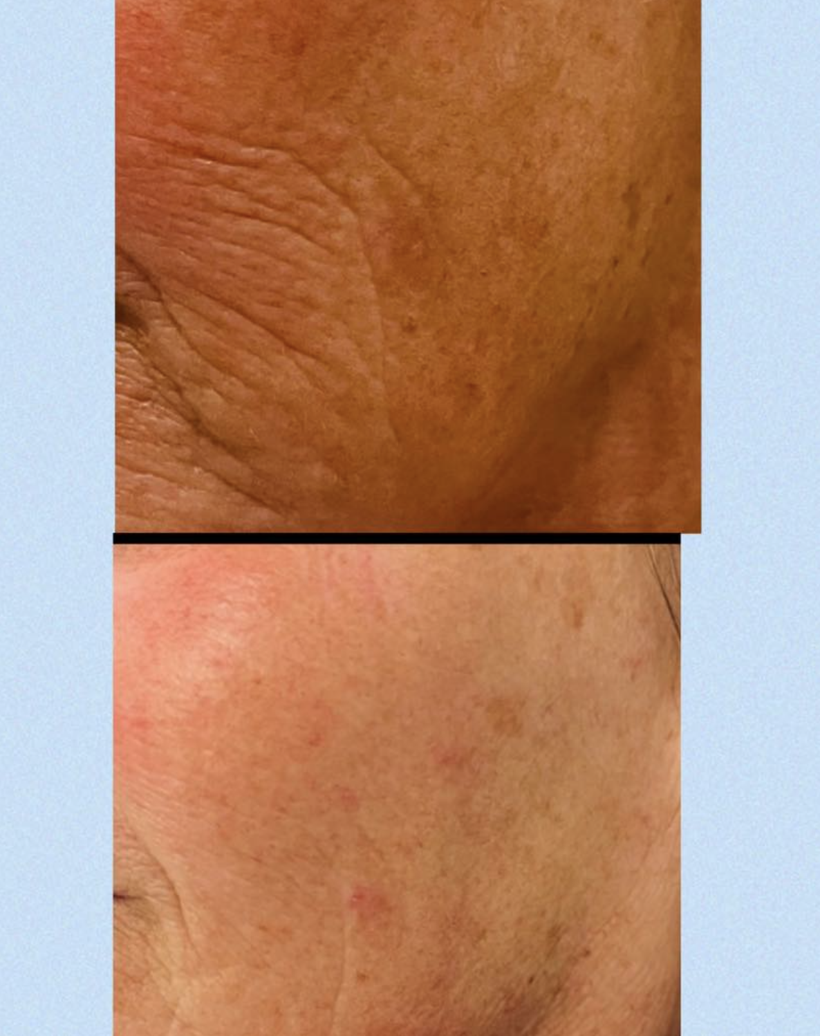 Skinbooster behandling hos Klinik Skin Rehab i Charlottenlund