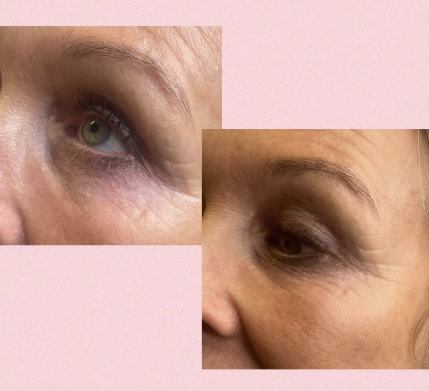 Før og efter billeder Klinik Skin Rehab i Charlottenlund og på Bornholm.