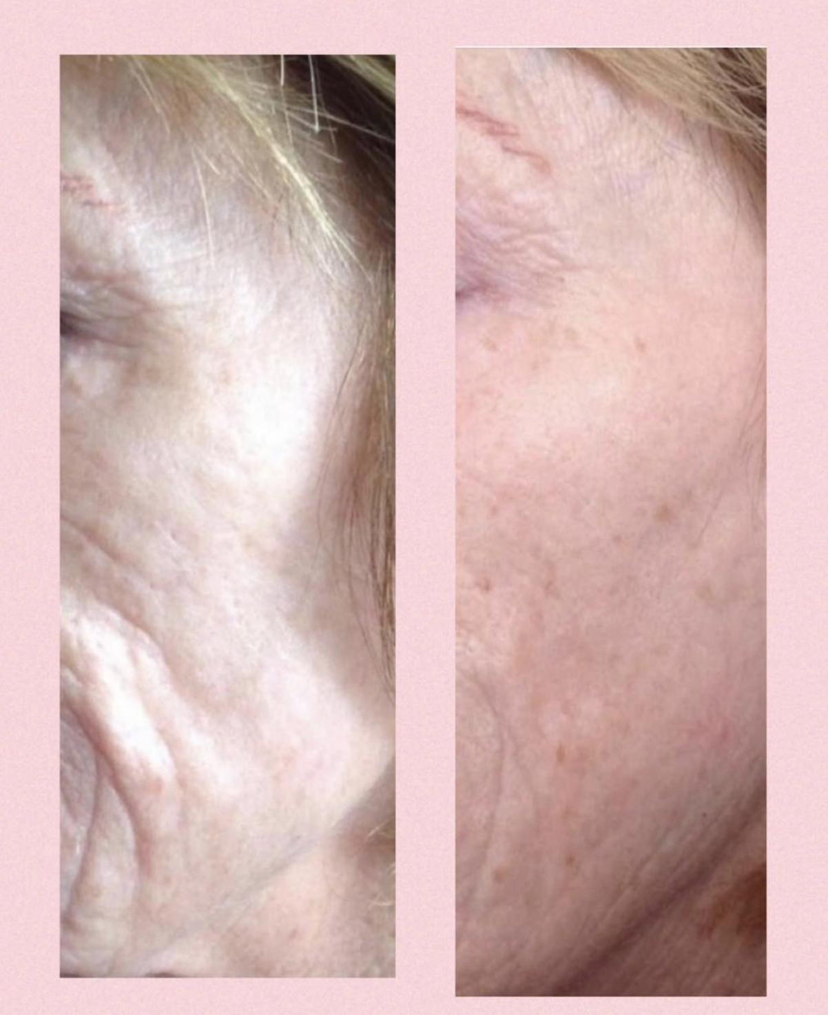 Profhilo behandling hos Klinik Skin Rehab i Charlottenlund